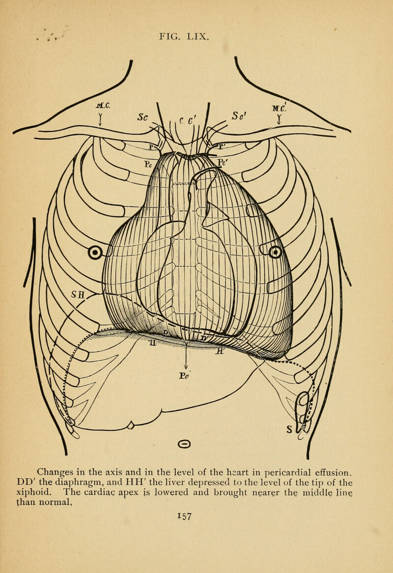 Changes in the axis and in the level of the heart in pericardial effusion. DD' the diaphragm, and HH' the liver depressed to the level of the tip of the xiphoid. The cardiaQ apex is lowered and brought nearer the middle lin^ than nornaal, J57