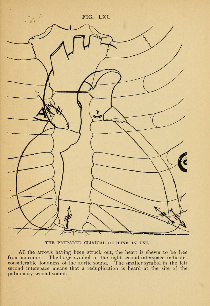 THE PREPARED CLINICAL OUTLINE IN USE. All the arrows having been struck out, the heart is shewn to be free from murmurs. The large symbol in the right second interspace indicates considerable loudness of the aortic sound. The smaller symbol in the left second interspace means that a reduplication is heard at the site of the pulmonary second sound.