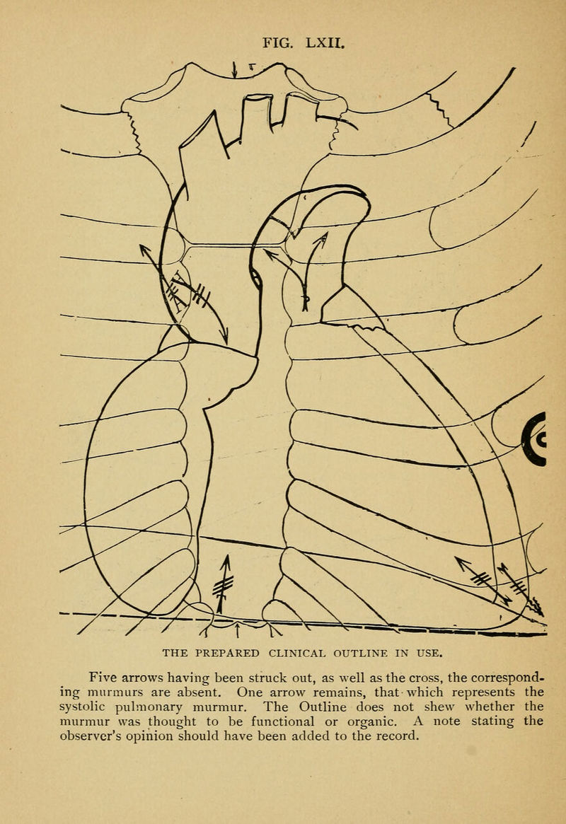 THE PREPARED CLINICAL OUTLINE IN USE. Five arrows having been struck out, as well as the cross, the correspond- ing murmurs are absent. One arrow remains, that which represents the systolic pulmonary murmur. The Outline does not shew whether the murmur was thought to be functional or organic. A note stating the observer's opinion should have been added to the record.