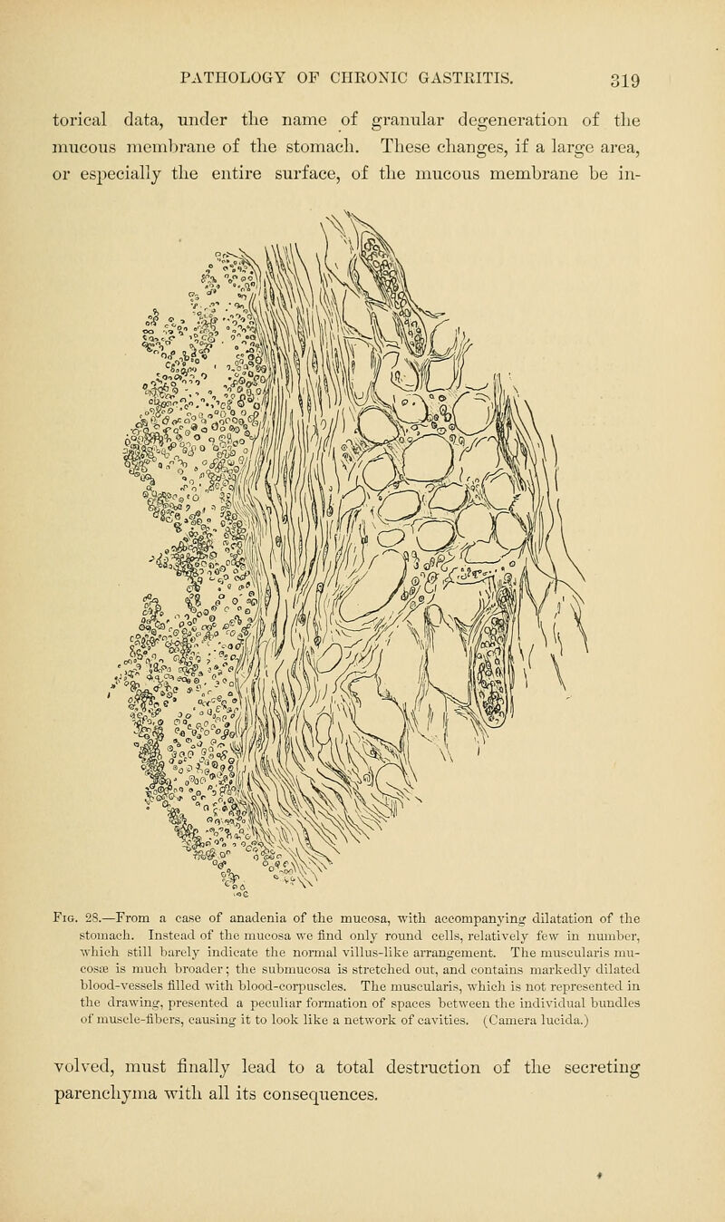 torical data, under tlie name of granular degeneration of the mucous membrane of the stomach. These changes, if a large area, or especially the entire surface, of the mucous membrane be in- FiG. 28.—From a case of anadenia of the mucosa, witli accompanying dilatation of the stomach. Instead of the mucosa we find only round cells, relatively few in number, which still barely indicate the normal villus-like arrangement. The muscularis mu- cosae is much broader; the submucosa is stretched out, and contains markedly dilated blood-vessels filled with blood-corpuscles. The muscularis, which is not represented in the drawing, presented a peculiar formation of spaces between the individual bundles of muscle-fibers, causing it to look like a network of cavities. (Camera lucida.) volved, must finally lead to a total destruction of the secreting parenchyma with all its consequences.