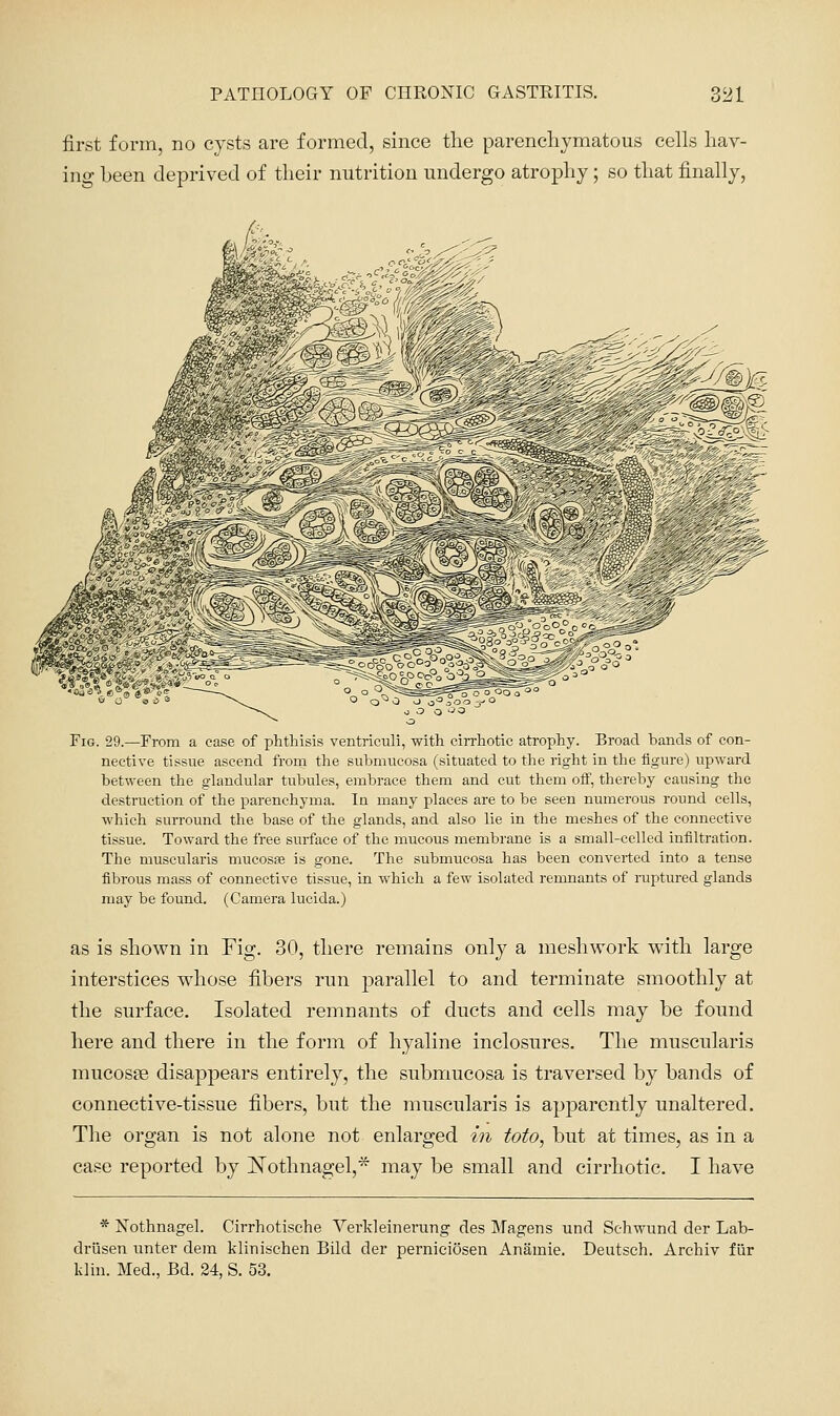 first form, no cysts are formed, since the parenchymatous cells hav- ing been deprived of their nutrition undergo atrophy; so that finally, Fig. 29.—From a case of phthisis ventriculi, with cirrhotic atrophy. Broad bands of con- nective tissue ascend from the submucosa (situated to the right in the figure) upward between the glandular tubules, embrace them and cut them off, thereby causing the destruction of the parenchyma. In many places are to be seen numerous round cells, which surround the base of the glands, and also lie in the meshes of the connective tissue. Toward the free surface of the mucous membrane is a small-celled infiltration. The muscularis mucosse is gone. The submucosa has been converted into a tense fibrous mass of connective tissue, in which a few isolated remnants of ruptured glands may be found. (Camera lucida.) as is shown in Fig. 30, there remains only a meshwork with large interstices whose fibers run parallel to and terminate smoothly at the surface. Isolated remnants of ducts and cells may be found here and there in the form of hyaline inclosures. The muscularis mucosae disappears entirely, the submucosa is traversed by bands of connective-tissue fibers, but the muscularis is apparently unaltered. The organ is not alone not enlarged in toto, but at times, as in a case reported by ]^othnagel,* may be small and cirrhotic. I have * Nothnagel. Cirrhotische Verkleinerung des Magens und Schwund der Lab- driisen unter dem klinischen Bild der pernici5sen Anamie. Deutsch. Archiv fur Idin. Med., Bd. 24, S. 53.