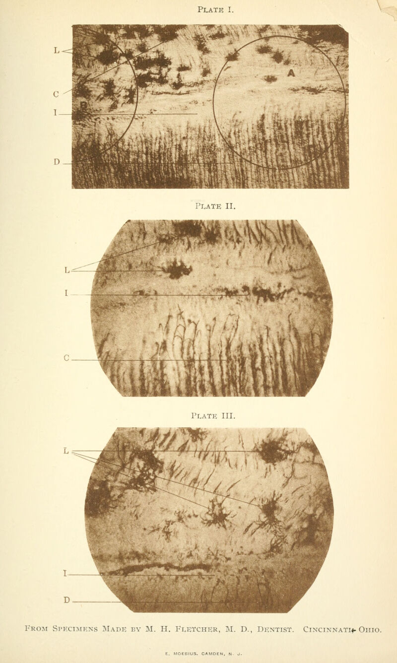 Plate II. Plate III. From Specimens Made by M. H. Fletcher, M. D., Dentist. Cincinnati*. Ohio. E. MOEBIUS. CAMDEh