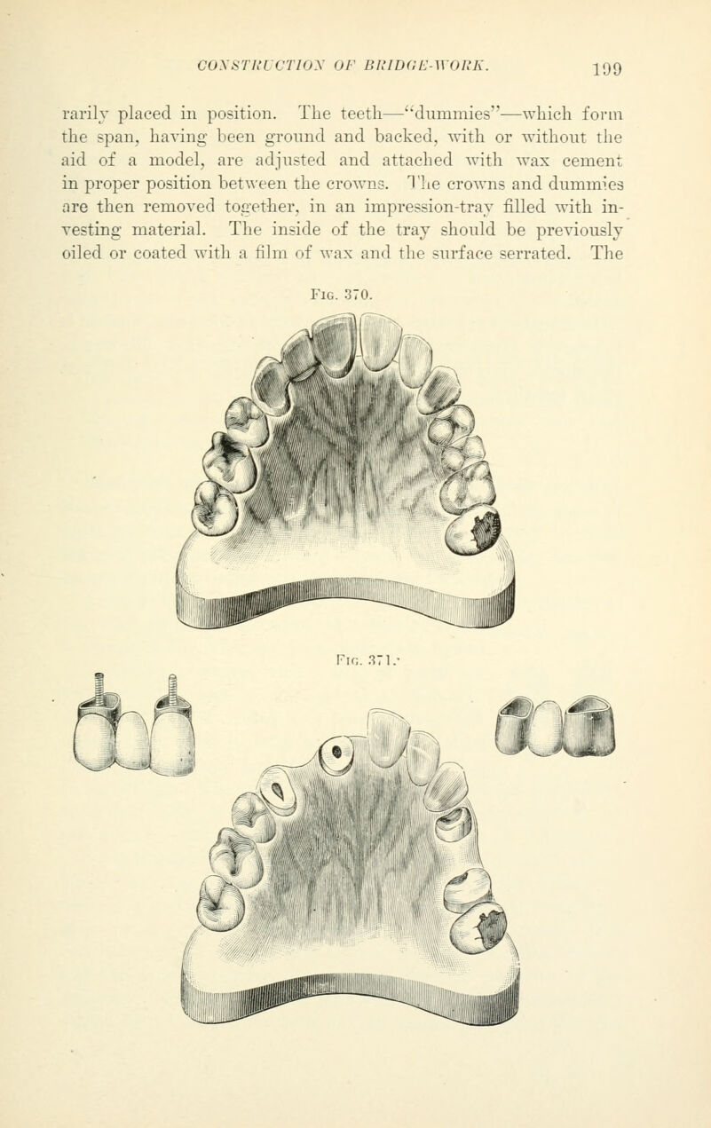 rarily placed in position. The teeth—dummies—which form the span, having been ground and backed, with or without the aid of a model, are adjusted and attached with wax cement in proper position between the crowns. The crowns and dummies are then removed together, in an impression-tray filled with in- vesting material. The inside of the tray should be previously oiled or coated with a film of wax and the surface serrated. The Fig. 370.