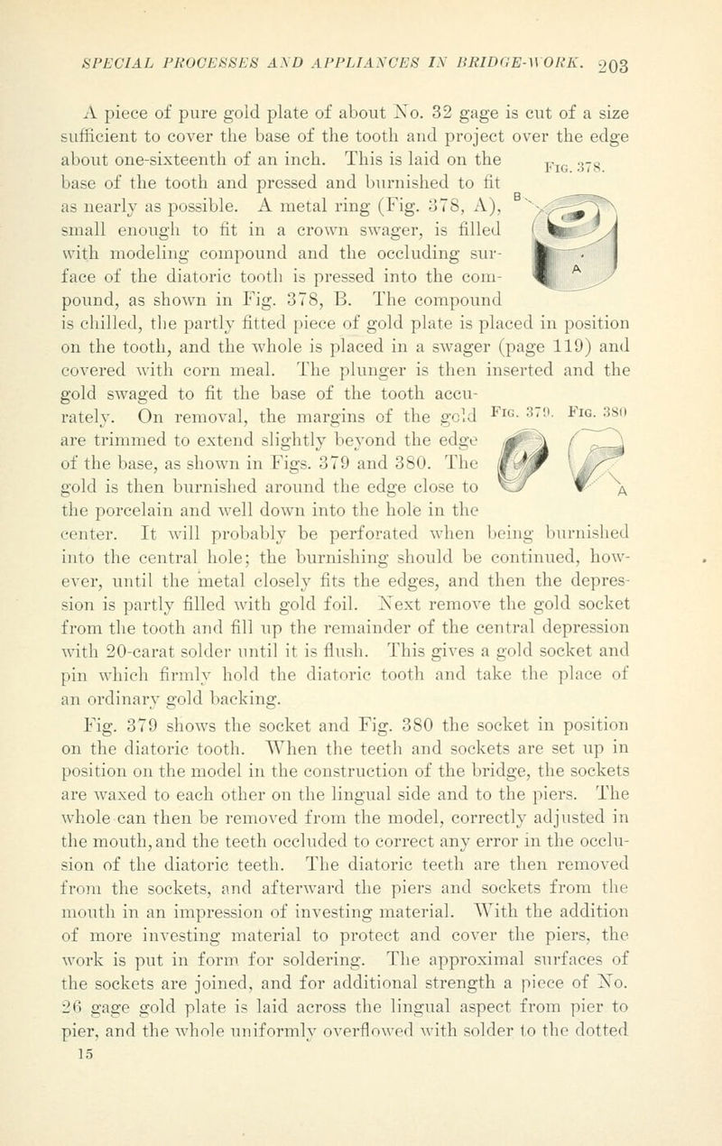 A piece of pure gold plate of about No. 32 gage is cut of a size sufficient to cover the base of the tooth and project over the edge about one-sixteenth of an inch. This is laid on the Fl(, .,-s base of the tooth and pressed and burnished to fit as nearly as possible. A metal ring (Fig. 378, A), » V small enough to fit in a crown swager, is filled ' W;:..--'A with modeling compound and the occluding sur- ■} face of the diatoric tooth is pressed into the com- ^|j: pound, as shown in Fig. 378, B. The compound is chilled, the partly fitted piece of gold plate is placed in position on the tooth, and the whole is placed in a swager (page 119) and covered with corn meal. The plunger is then inserted and the gold swaged to fit the base of the tooth accu- rately. On removal, the margins of the geld ] are trimmed to extend slightly beyond the edge of the base, as shown in Figs. 379 and 380. The gold is then burnished around the edge close to the porcelain and well down into the hole in the center. It will probably be perforated when being burnished into the central hole; the burnishing should be continued, how- ever, until the metal closely fits the edges, and then the depres- sion is partly filled with gold foil. Next remove the gold socket from the tooth and fill up the remainder of the central depression with 20-carat solder until it is flush. This gives a gold socket and pin which firmly hold the diatoric tooth and take the place of an ordinary gold backing. Fig. 379 shows the socket and Fig. 380 the socket in position on the diatoric tooth. When the teeth and sockets are set up in position on the model in the construction of the bridge, the sockets are waxed to each other on the lingual side and to the piers. The whole can then be removed from the model, correctly adjusted in the mouth, and the teeth occluded to correct any error in the occlu- sion of the diatoric teeth. The diatoric teeth are then removed from the sockets, and afterward the piers and sockets from the mouth in an impression of investing material. With the addition of more investing material to protect and cover the piers, the work is put in form for soldering. The approximal surfaces of the sockets are joined, and for additional strength a piece of No. 26 gage gold plate is laid across the lingual aspect from pier to pier, and the whole uniformly overflowed with solder to the dotted 15