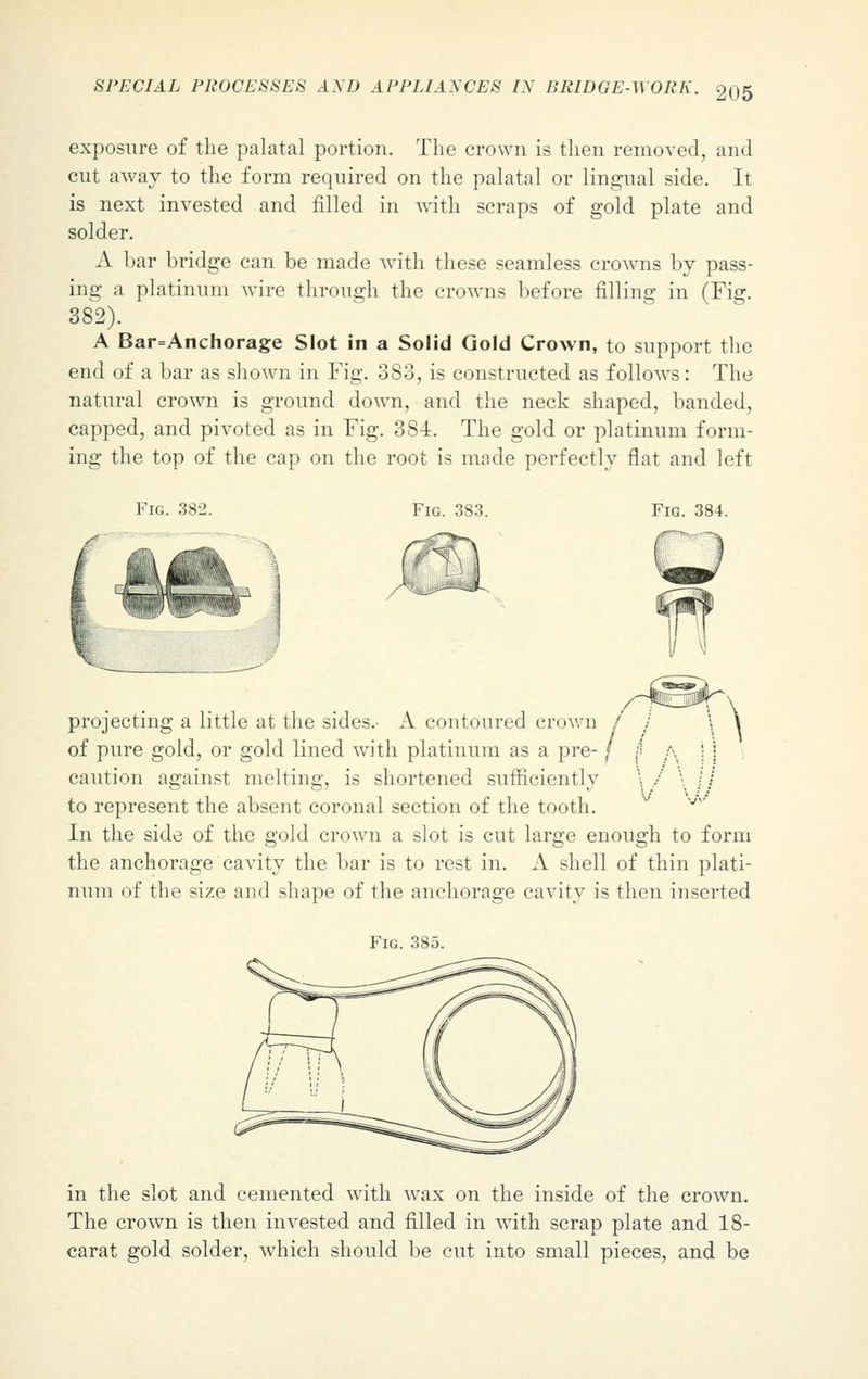exposure of the palatal portion. The crown is then removed, and cut away to the form required on the palatal or lingual side. It is next invested and filled in with scraps of gold plate and solder. A bar bridge can be made with these seamless crowns by pass- ing a platinum wire through the crowns before filling in (Fig. 382). A Bar=Anchorage Slot in a Solid Gold Crown, to support the end of a bar as shown in Fig. 383, is constructed as follows: The natural crown is ground down, and the neck shaped, banded, capped, and pivoted as in Fig. 384. The gold or platinum form- ing the top of the cap on the root is made perfectly flat and left Fig. 3S3. Fig. 384. projecting a little at the sides.- A contoured crown of pure gold, or gold lined with platinum as a pre- caution against melting, is shortened sufficiently \ / \ i i to represent the absent coronal section of the tooth. v In the side of the gold crown a slot is cut large enough to form the anchorage cavity the bar is to rest in. A shell of thin plati- num of the size and shape of the anchorage cavity is then inserted Fig. 385. in the slot and cemented with wax on the inside of the crown. The crown is then invested and filled in with scrap plate and 18- carat gold solder, which should be cut into small pieces, and be