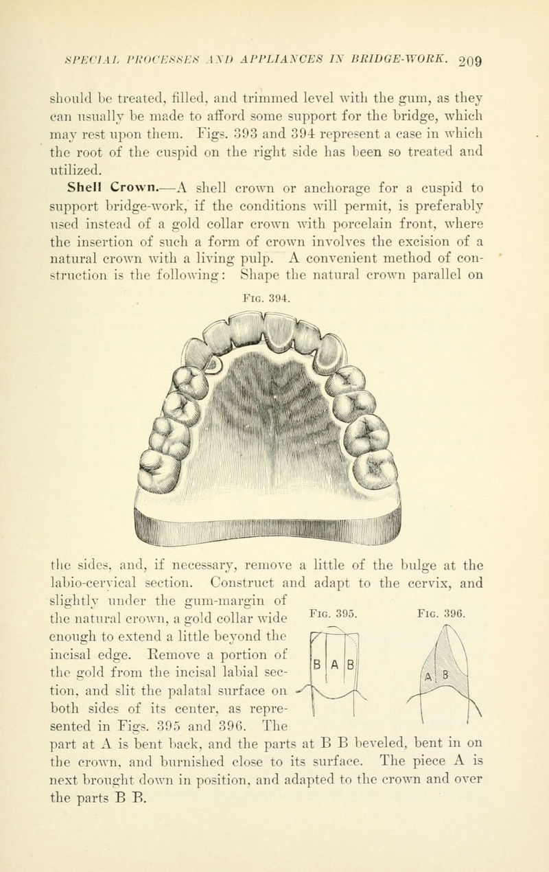 should be treated, filled, and trimmed level with the gum, as they can usually be made to afford some support for the bridge, which may rest upon them. Fig?. 393 and 394 represent a case in which the root of the cuspid on the right side has been so treated and utilized. Shell Crown—A shell crown or anchorage for a cuspid to support bridge-work, if the conditions will permit, is preferably used instead of a gold collar crown with porcelain front, where the insertion of such a form of crown involves the excision of a natural crown with a living pulp. A convenient method of con- struction is the following: Shape the natural crown parallel on Fig. 394. Fig. 396. the sides, and, if necessary, remove a little of the bulge at the labio-cervical section. Construct and adapt to the cervix, and slightly under the gum-margin of the natural crown, a gold collar wide enough to extend a little beyond the incisal edge. Remove a portion of the gold from the incisal labial sec- tion, and slit the palatal surface on both sides of its center, as repre- sented in Pigs. 395 and 396. The part at A is bent back, and the parts at B B beveled, bent in on the crown, and burnished close to its surface. The piece A is next brought down in position, and adapted to the crown and over the parts B B.