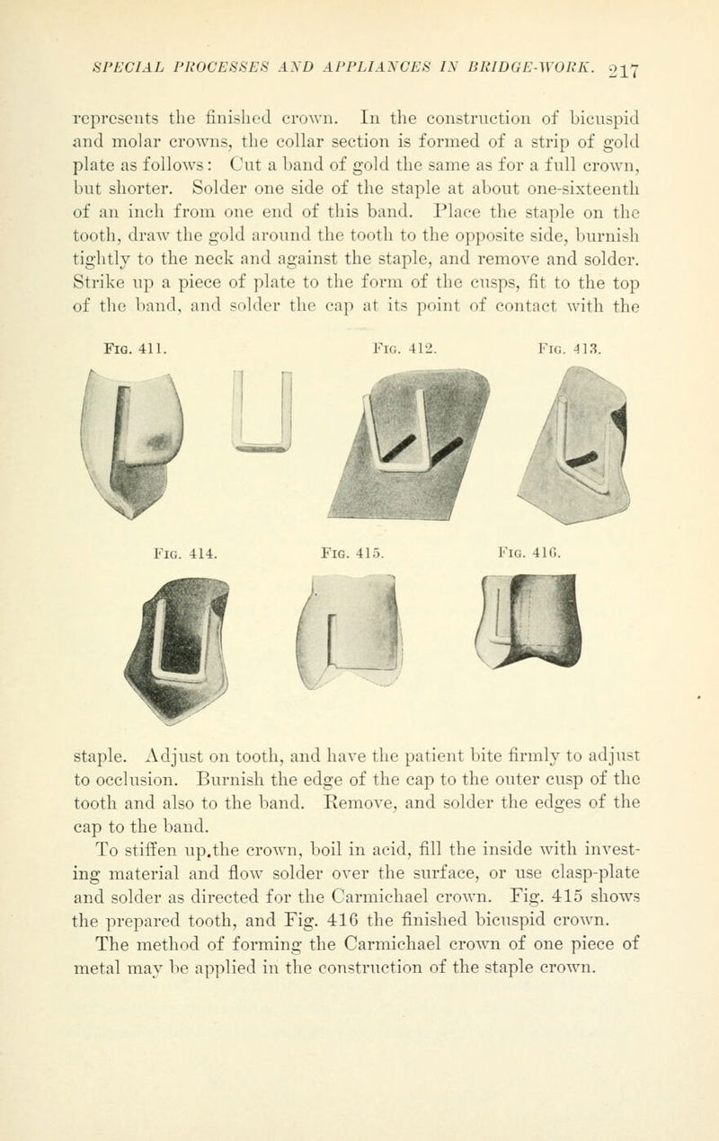 represents the finished crown. In the construction of bicuspid and molar crowns, the collar section is formed of a strip of gold plate as follows: Cut a band of gold the same as for a full crown, but shorter. Solder one side of the staple at about one-sixteenth of an inch from one end of this band. Place the staple on the tooth, draw the gold around the tooth to the opposite side, burnish tightly to the neck and against the staple, and remove and solder. Strike up a piece of plate to the form of the cusps, fit to the top of the band, and snider the cap at its point of contact with the Fig. 411. Fig. 412. Fig. 413. \SY Fig. 414. Fig. 415. Fig. 41G. i staple. Adjust on tooth, and have the patient bite firmly to adjust to occlusion. Burnish the edge of the cap to the outer cusp of the tooth and also to the band. Eemove, and solder the edges of the cap to the band. To stiffen up.the crown, boil in acid, fill the inside with invest- ing material and flow solder over the surface, or use clasp-plate and solder as directed for the Carmichael crown. Fig. 415 shows the prepared tooth, and Fig. 416 the finished bicuspid crown. The method of forming the Carmichael crown of one piece of metal may be applied in the construction of the staple crown.