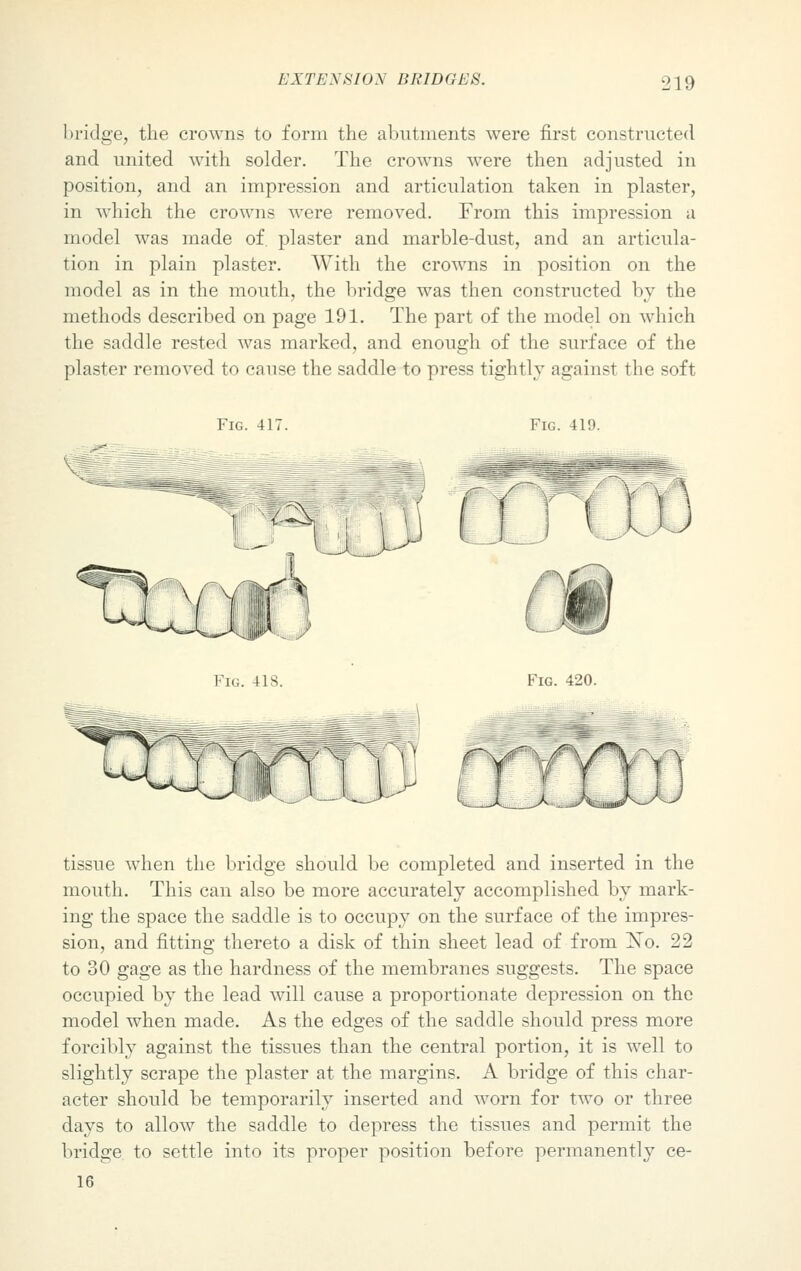 bridge, the crowns to form the abutments were first constructed and united with solder. The crowns were then adjusted in position, and an impression and articulation taken in plaster, in which the crowns were removed. From this impression a model was made of. plaster and marble-dust, and an articula- tion in plain plaster. With the crowns in position on the model as in the mouth, the bridge was then constructed by the methods described on page 191. The part of the model on which the saddle rested was marked, and enough of the surface of the plaster removed to cause the saddle to press tightly against the soft Fig. 417. Fig. 419. Fig. 418. Fig. 420. tissue when the bridge should be completed and inserted in the mouth. This can also be more accurately accomplished by mark- ing the space the saddle is to occupy on the surface of the impres- sion, and fitting thereto a disk of thin sheet lead of from !STo. 22 to 30 gage as the hardness of the membranes suggests. The space occupied by the lead will cause a proportionate depression on the model when made. As the edges of the saddle should press more forcibly against the tissues than the central portion, it is well to slightly scrape the plaster at the margins. A bridge of this char- acter should be temporarily inserted and worn for two or three days to allow the saddle to depress the tissues and permit the bridge to settle into its proper position before permanently ce- 16