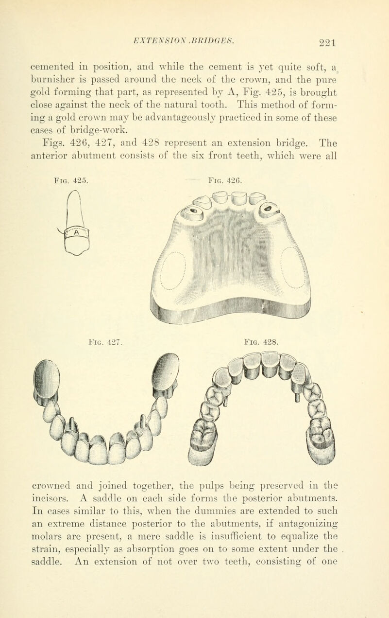 cemented in position, and while the cement is yet quite soft, a burnisher is passed around the neck of the crown, and the pure gold forming that part, as represented by A, Fig. 425, is brought close against the neck of the natural tooth. This method of form- ing a gold crown may be advantageously practiced in some of these cases of bridge-work. Figs. 426, 427, and 428 represent an extension bridge. The anterior abutment consists of the six front teeth, which were all Fig. 425. Fin. 426. JC Fig. 427. Fig. 428. crowned and joined together, the pulps being preserved in the incisors. A saddle on each side forms the posterior abutments. In cases similar to this, when the dummies are extended to such an extreme distance posterior to the abutments, if antagonizing molars are present, a mere saddle is insufficient to equalize the strain, especially as absorption goes on to some extent under the saddle. An extension of not over two teeth, consisting of one