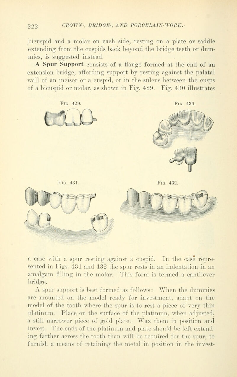 bicuspid and a molar on each side, resting on a plate or saddle extending from the cuspids back beyond the bridge teeth or dum- mies, is suggested instead. A Spur Support consists of a flange formed at the end of an extension bridge, affording support by resting against the palatal wall of an incisor or a cuspid, or in the sulcus between the cusps of a bicuspid or molar, as shown in Fig. 429. Fig. 430 illustrates Fig. 429. Fig. 431. Fig. 432. a case with a spur resting against a cuspid. In the case repre- sented in Figs. 431 and 432 the spur rests in an indentation in an amalgam filling in the molar. This form is termed a cantilever bridge. A spur support is best formed as follows: When the dummies are mounted on the model ready for investment, adapt on the model of the tooth where the spur is to rest a piece of very thin platinum. Place on the surface of the platinum, when adjusted, a still narrower piece of gold plate. Wax them in position and invest. The ends of the platinum and plate should be left extend- ing farther across the tooth than will lie required for the spur, to furnish a means of retaining the metal in position in the invest-