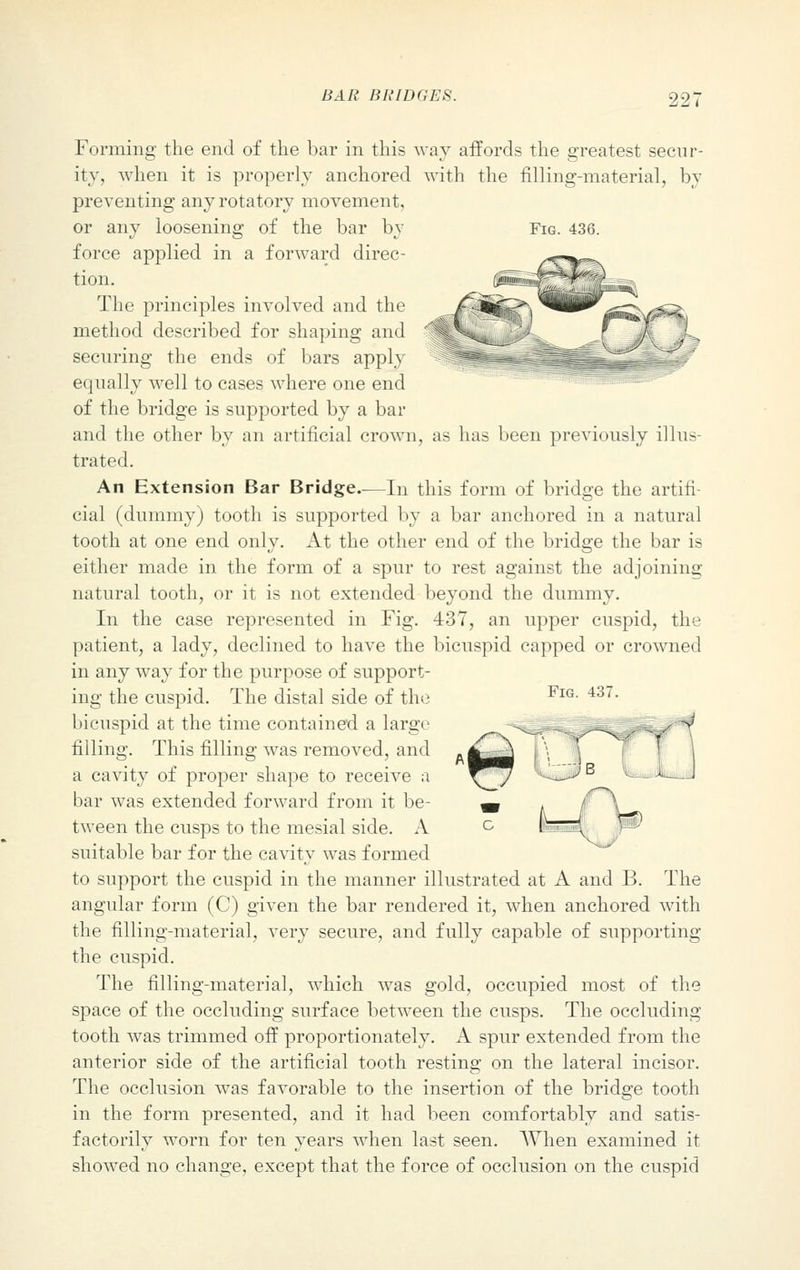 22' Fig. 436. ^■tfe^^j Forming the end of the bar in this way affords the greatest secur- ity, when it is properly anchored with the filling-material, by preventing any rotatory movement, or any loosening of the bar by force applied in a forward direc- tion. The principles involved and the method described for shaping and securing the ends of bars apply equally well to cases where one end of the bridge is supported by a bar and the other by an artificial crown, as has been previously illus- trated. An Extension Bar Bridge..—In this form of bridge the artifi- cial (dummy) tooth is supported by a bar anchored in a natural tooth at one end only. At the other end of the bridge the bar is either made in the form of a spur to rest against the adjoining- natural tooth, or it is not extended beyond the dummy. In the case represented in Fig. 437, an upper cuspid, the patient, a lady, declined to have the bicuspid capped or crowned in any way for the purpose of support- ing the cuspid. The distal side of the bicuspid at the time contained a large filling. This filling was removed, and a cavity of proper shape to receive a bar was extended forward from it be- tween the cusps to the mesial side. A suitable bar for the cavity was formed to support the cuspid in the manner illustrated at A and B. The angular form (C) given the bar rendered it, when anchored with the filling-material, very secure, and fully capable of supporting the cuspid. The filling-material, which was gold, occupied most of the space of the occluding surface between the cusps. The occluding tooth was trimmed off proportionately. A spur extended from the anterior side of the artificial tooth resting on the lateral incisor. The occlusion was favorable to the insertion of the bridge tooth in the form presented, and it had been comfortably and satis- factorily worn for ten years when last seen. When examined it showed no change, except that the force of occlusion on the cuspid