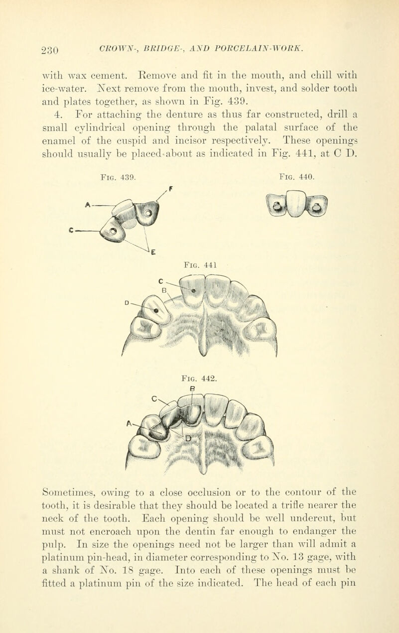 with wax cement. Remove and fit in the mouth, and chill with ice-water. Next remove from the mouth, invest, and solder tooth and plates together, as shown in Fig. 439. 4. For attaching the denture as thus far constructed, drill a small cylindrical opening through the palatal surface of the enamel of the cuspid and incisor respectively. These openings should usually be placed-about as indicated in Fig. 441, at C I). Fig. 439. Fig. 440. Sometimes, owing to a close occlusion or to the contour of the tooth, it is desirable that they should be located a trifle nearer the neck of the tooth. Each opening should be well undercut, but must not encroach upon the dentin far enough to endanger the pulp. In size the openings need not be larger than will admit a platinum pin-head, in diameter corresponding to No. 13 gage, with a shank of No. 18 gage. Into each of these openings must be fitted a platinum pin of the size indicated. The head of each pin