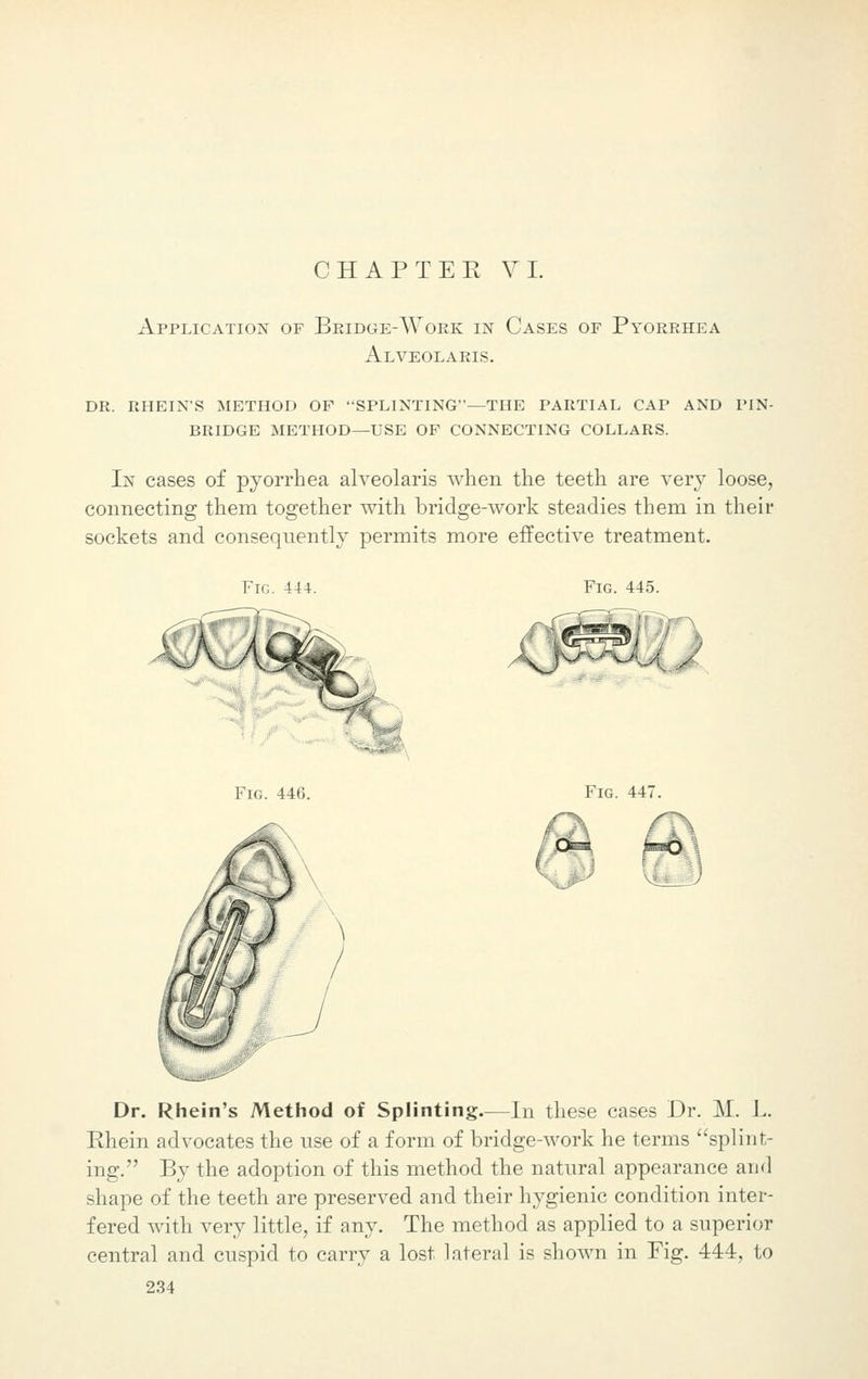 Application of Bridge-Work in Cases of Pyorrhea Alveolakis. dr. rhein's method of splinting—the partial cap and pin- bridge method—use of connecting collars. In cases of pyorrhea alveolaris when the teeth are very loose, connecting them together with bridge-work steadies them in their sockets and consequently permits more effective treatment. Fig. 444. Fig. 445. Fig. 446. Fig. 447. Dr. Rhein's Method of Splinting—In these cases Dr. M. L. Rhein advocates the use of a form of bridge-work he terms splint- ing. By the adoption of this method the natural appearance and shape of the teeth are preserved and their hygienic condition inter- fered with very little, if any. The method as applied to a superior central and cuspid to carry a lost lateral is shown in Fig. 444, to