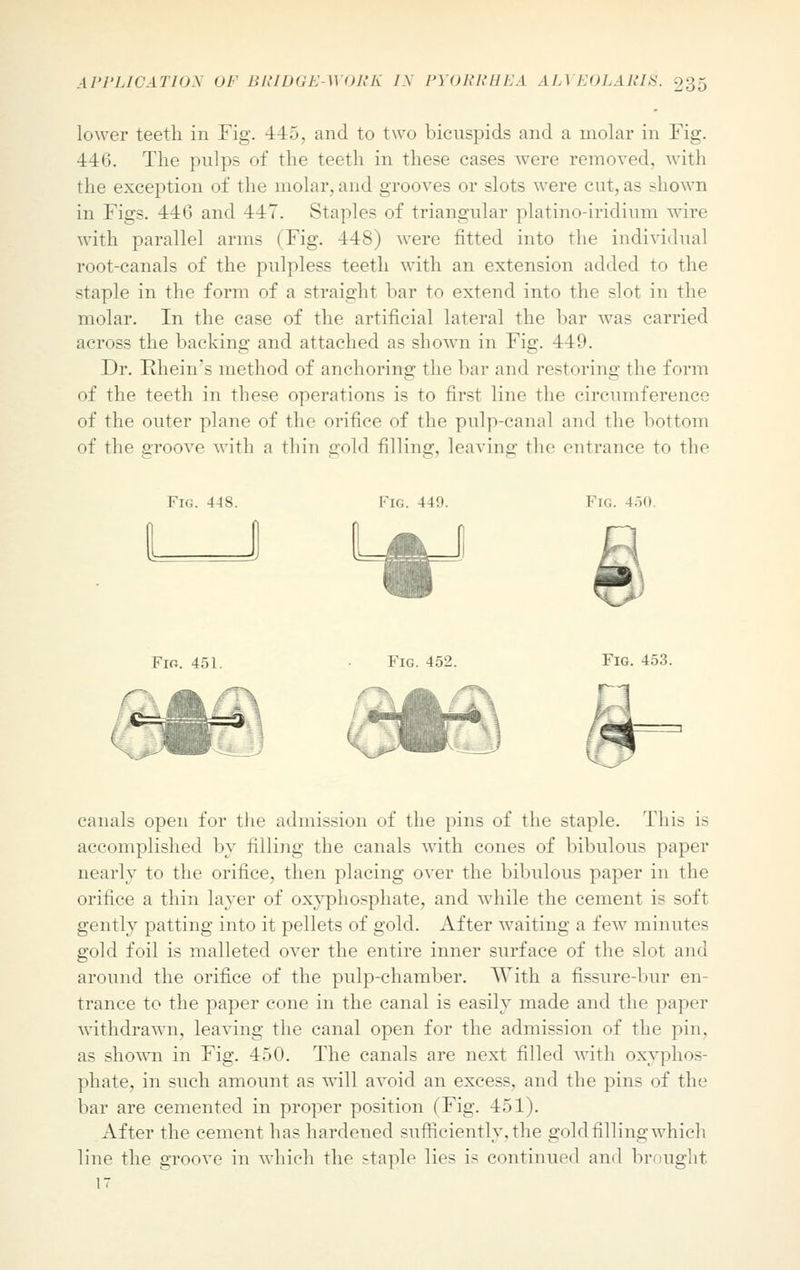 lower teeth in Fig. 445, and to two bicuspids and a molar in Fig. 446. The pulps of the teeth in these cases were removed, with the exception of the molar, and grooves or slots were cut, as shown in Figs. 44G and 447. Staples of triangular platino-iridinm wire with parallel arms (Fig. 448) were fitted into the individual root-canals of the pnlpless teeth with an extension added to the staple in the form of a straight bar to extend into the slot in the molar. In the case of the artificial lateral the bar was carried across the backing and attached as shown in Fig. 449. Dr. Ehein's method of anchoring the bar and restoring rlie form of the teeth in these operations is to first lino the circumference of the outer plane of the orifice of the pulp-canal and the bottom of the groove with a thin gold filling, leaving the entrance to the Fig. 4-18. Fig. 440. Fig. 450. LaJ Fig. 451. Fig. 452. Fig. 453. canals open for the admission of the pins of the staple. This is accomplished by filling the canals with cones of bibulous paper nearly to the orifice, then placing over the bibulous paper in the orifice a thin layer of oxyphosphate, and while the cement is soft gently patting into it pellets of gold. After waiting a few minutes gold foil is malleted over the entire inner surface of the slot and around the orifice of the pulp-chamber. With a fissure-bur en- trance to the paper cone in the canal is easily made and the paper withdrawn, leaving the canal open for the admission of the pin, as shown in Fig. 450. The canals are next filled with oxyphos- phate, in such amount as will avoid an excess, and the pins of the bar are cemented in proper position (Fig. 451). After the cement has hardened sufficiently, the gold filling which line the groove in which the staple lies is continued and brought 17