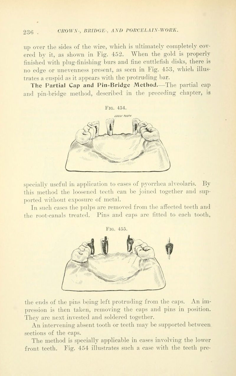 up over the sides of the wire, which is ultimately completely cov- ered by it, as shown in Fig. 452. When the gold is properly finished with plug-finishing burs and fine cuttlefish disks, there is no edge or unevenness present, as seen in Fig. 453, which illus- trates a cuspid as it appears with the protruding bar. The Partial Cap and Pin=Bridge Method.—The partial cap and pin-bridge method, described in the preceding chapter, is Fig. 454. ioosf tooth specially useful in application to cases of pyorrhea alveolaris. By this method the loosened teeth can be joined together and sup- ported without exposure of metal. In such cases the pulps are removed from the affected teeth and the root-canals treated. Pins and cup- are fitted to each tooth, Fig. 455. the ends of the pins being left protruding from the caps. An im- pression is then taken, removing the caps and pins in position. They are next invested and soldered together. An intervening absent tooth or teeth may be supported between sections of the caps. The method is specially applicable in cases involving the lower front teeth. Fig. 454 illustrates such a case with the teeth pre-