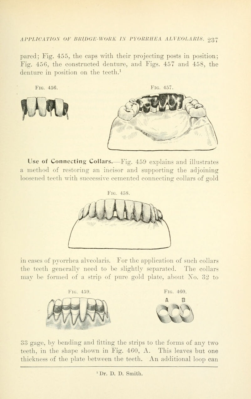 pared; Fig. 455, the caps with their projecting posts in position; Fig. 456, the constructed denture, and Figs. 457 and 458, the denture in position on the teeth.1 Fig. 456. Fig. 4 Use of Connecting Collars—Fig. 459 explains and illustrates a method of restoring an incisor and supporting the adjoining Loosened teeth with successive cemented c<nnn.-<-uiiir collars of gold Fig. 458. in cases of pyorrhea alveolaris. For the application of such collars the teeth generally need to be slightly separated. The collars may be formed of a strip of pure gold plate, about Xo. 32 to Fig. 459. 33 gage, by bending and fitting the strips to the forms of any two teeth, in the shape shown in Fig. 460, A. This leaves but one thickness of the plate between the teeth. An additional loop can Dr. D. D. Smith.