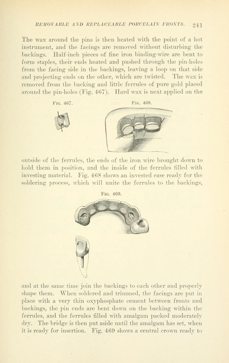 The wax around the pins is then heated with the point of a hot instrument, and the facings are removed without disturbing the backings. Half-inch pieces of fine iron binding-wire are bent to form staples, their ends heated and pushed through the pin-holes from the facing side in the backings, leaving a loop on that side and projecting ends on the other, which are twisted. The wax is removed from the I lacking and little ferrules of pure gold placed around the pin-holes ( Fig. 467). Hard wax is next applied on the Fig. 467. Fig. 468. outside of the ferrules, the ends of the iron wire brought down to hold them in position, and the inside of the ferrules filled with investing material. Fig. 468 shows an invested case ready for the soldering process, which will unite the ferrules to the backings, Fig. 469. and at the same time join the backings to each other and properly shape them. When soldered and trimmed, the facings are put in place with a very thin oxyphosphate cement between fronts and backings, the pin ends are bent down on the backing within the ferrules, and the ferrules filled with amalgam packed moderately dry. The bridge is then put aside until the amalgam has set, when it is ready for insertion. Fig. 469 shows a central crown ready to