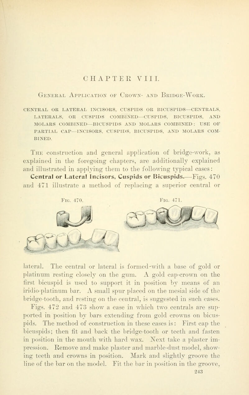 General Application of Crown- and Bridge-Work. central or lateral incisors, cuspids or bicuspids—centrals, laterals, or cuspids combined—cuspids, bicuspids, and molars combined—bicuspids and molars combined: use of partial cap—incisors. cuspids, bicuspids, and molars com- BINED. The construction and general application of bridge-work, as explained in the foregoing chapters, are additionally explained and illustrated in applying them to the following typical cases: Central or Lateral Incisors, Cuspids or Bicuspids.—Figs. 470 and 471 illustrate a method of replacing a superior central or Fig. 470. Fig. 471. lateral. The central or lateral is formed-with a base of gold or platinum resting closely on the gum. A gold cap-crown on the first bicuspid is used to support it in position by means of an iridio-platinum bar. A small spur placed on the mesial side of the bridge-tooth, and resting on the central, is suggested in such cases. Figs. 472 and 473 show a case in which two centrals are sup- ported in position by bars extending from gold crowns on bicus- pids. The method of construction in these cases is: First cap the bicuspids; then fit and back the bridge-tooth or teeth and fasten in position in the mouth with hard wax. Next take a plaster im- pression. Remove and make plaster and marble-dust model, show- ing teeth and crowns in position. Mark and slightly groove the line of the bar on the model. Fit the bar in position in the groove,