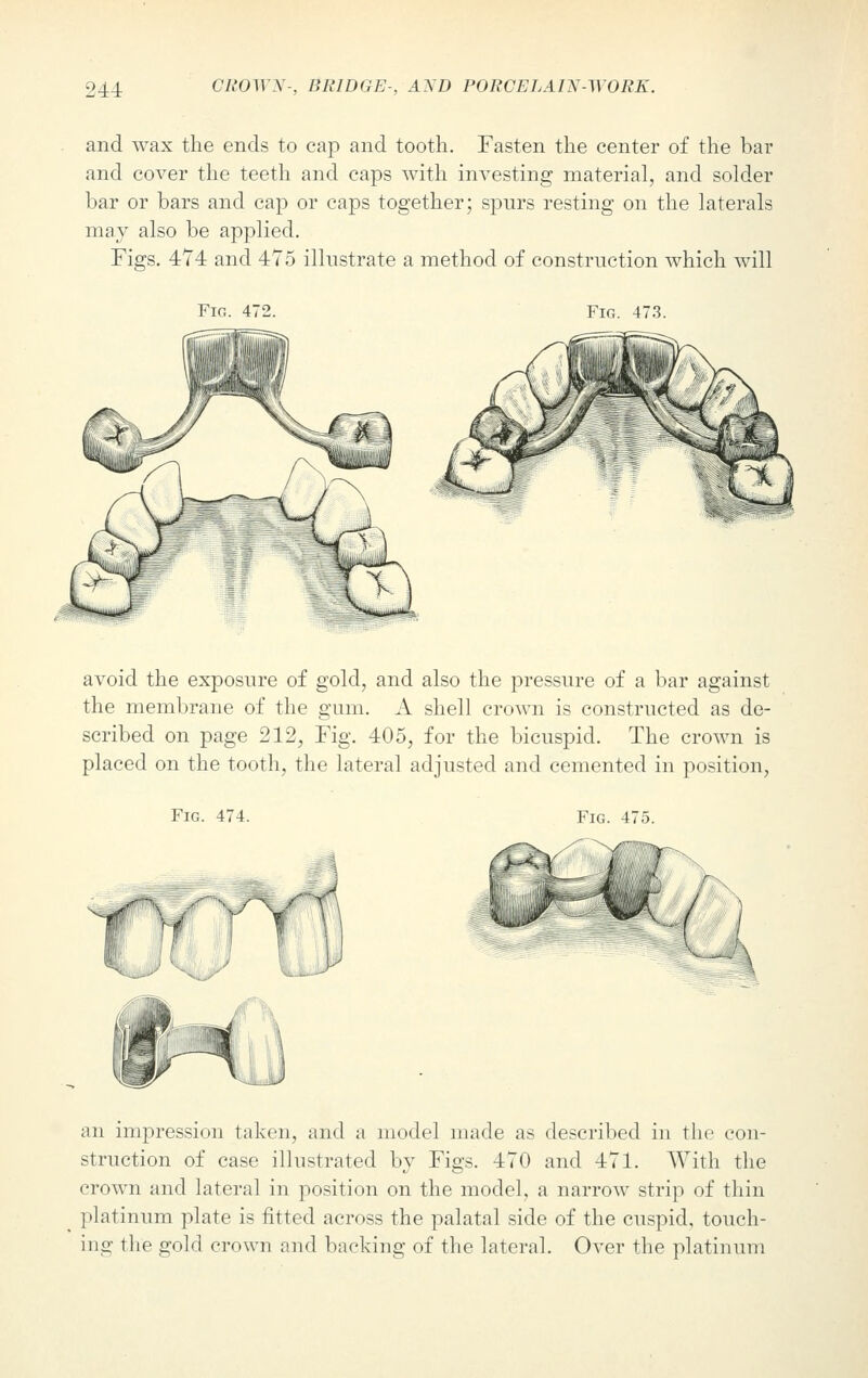 and wax the ends to cap and tooth. Fasten the center of the bar and cover the teeth and caps with investing material, and solder bar or bars and cap or caps together; spurs resting on the laterals may also be applied. Figs. 474 and 475 illustrate a method of construction which will Fig. 472. Fig. 473. avoid the exposure of gold, and also the pressure of a bar against the membrane of the gum. A shell crown is constructed as de- scribed on page 212, Fig. 405, for the bicuspid. The crown is placed on the tooth, the lateral adjusted and cemented in position, Fig. 474. Fig. 475. an impression taken, and a model made as described in the con- struction of case illustrated by Figs. 470 and 471. With the crown and lateral in position on the model, a narrow strip of thin platinum plate is fitted across the palatal side of the cuspid, touch- ing the gold crown and backing of the lateral. Over the platinum