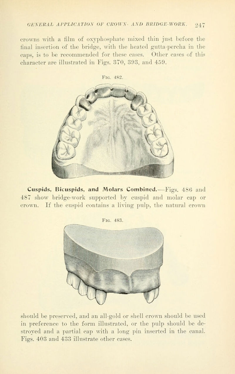 crowns with a film of oxyphosphate mixed thin just before the final insertion of the bridge, with the heated gutta-percha in the caps, is to be recommended for these cases. Other cases of this character are illustrated in Figs. 370, 393, and 459. Cuspids, Bicuspids, and Molars Combined.—Figs. 486 and 487 show bridge-work supported by cuspid and molar cap or crown. If the cuspid contains a living pulp, the natural crown Fig. 483. should be preserved, and an all-gold or shell crown should be used in preference to the form illustrated, or the pulp should be de- stroyed and a partial cap with a long pin inserted in the canal. Figs. 403 and 433 illustrate other cases.