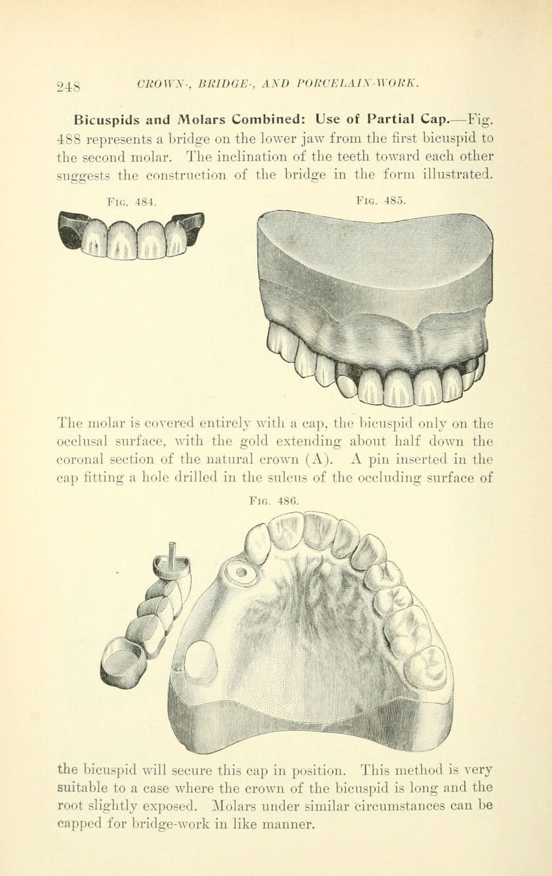 Bicuspids and Molars Combined: Use of Partial Cap.—Fig. 488 represents a bridge on the lower jaw from the first bicuspid to the second molar. The inclination of the teeth toward each other suggests the construction of the bridge in the form illustrated. Fig. 484. Fig. 485. The molar is covered entirely with a cap, the bicuspid only on the occlusal surface, with the gold extending about half down the coronal section of the natural crown (A ). A pin inserted in the cap fitting a hole drilled in the sulcus of the occluding surface of Fig. 486. the bicuspid will secure this cap in position. This method is very suitable to a case where the crown of the bicuspid is long and the root slightly exposed. Molars under similar circumstances can be capped for bridge-work in like manner.