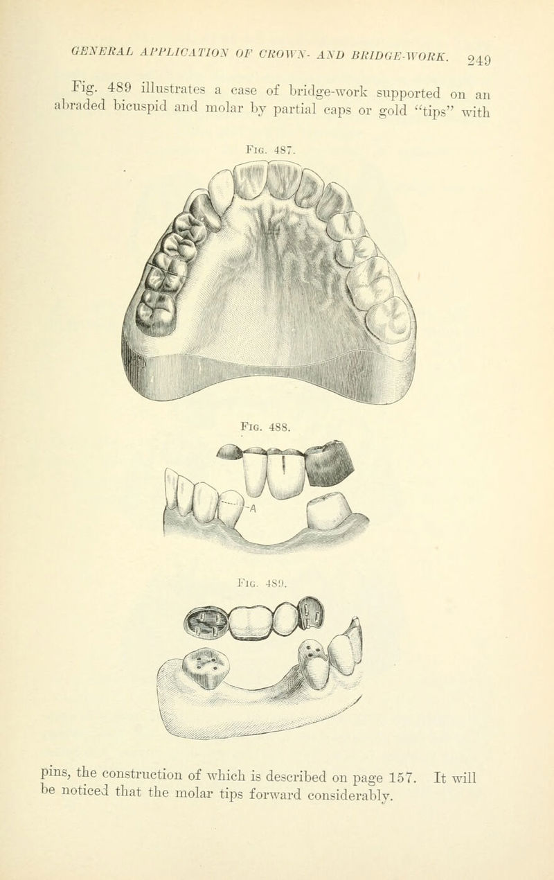Fig. 489 illustrates a case of bridge-work supported on an abraded bicuspid and molar by partial caps or gold tips with Fig. 487. Fig. 4S8. Fig. 4S9. pins, the construction of which is described on page 157. It will be noticed that the molar tips forward considerably.