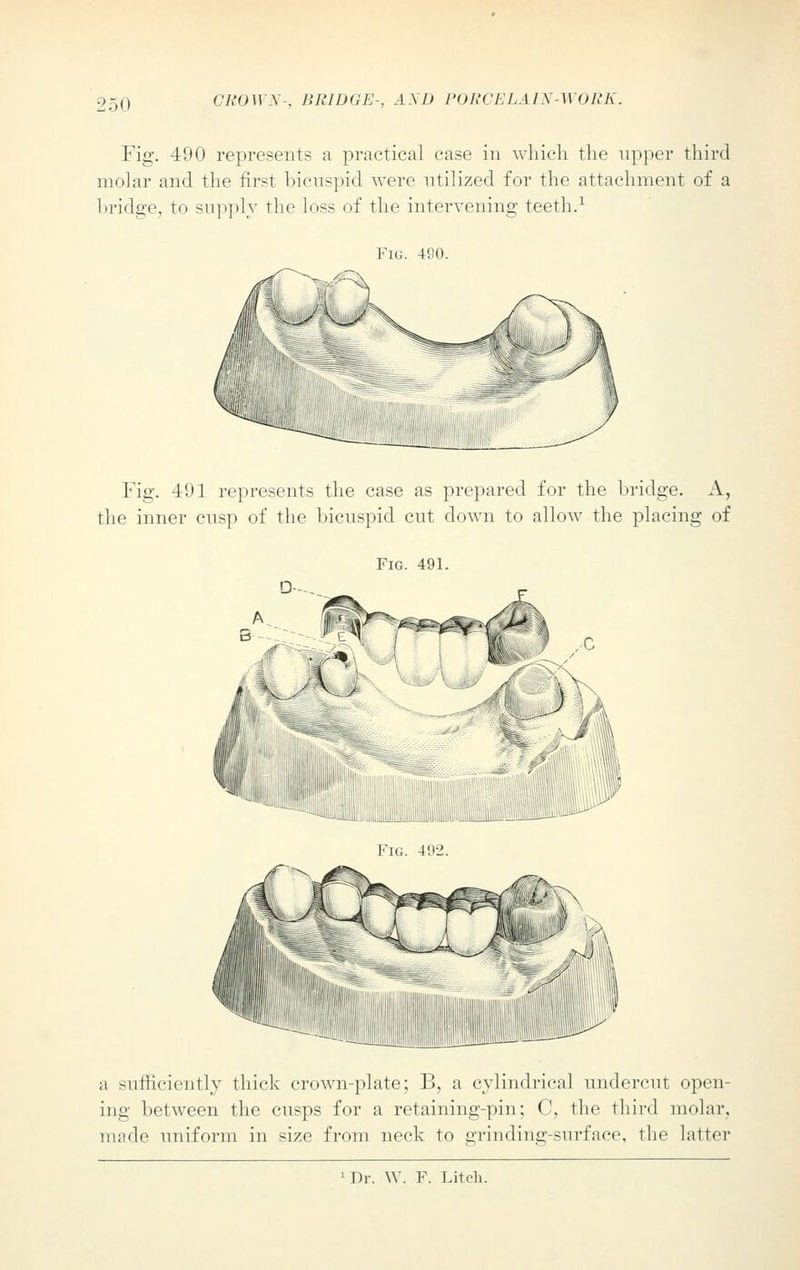 Fig. 490 represents a practical case in which the upper third molar and the first bicuspid were utilized for the attachment of a bridge, to supply the loss of the intervening teeth.1 Fig. 490. Fig. 491 represents the case as prepared for the bridge. A, the inner cusp of the bicuspid cut clown to allow the placing of Fig. 491. D--. ~~JUUMulillllLi.ililiiili!ll^ Fig. 492. a sufficiently thick crown-plate; B, a cylindrical undercut open- ing between the cusps for a retaining-pin; 0. the third molar, made uniform in size from neck to grinding-surface, the latter 1 Dr. W. F. Litch.