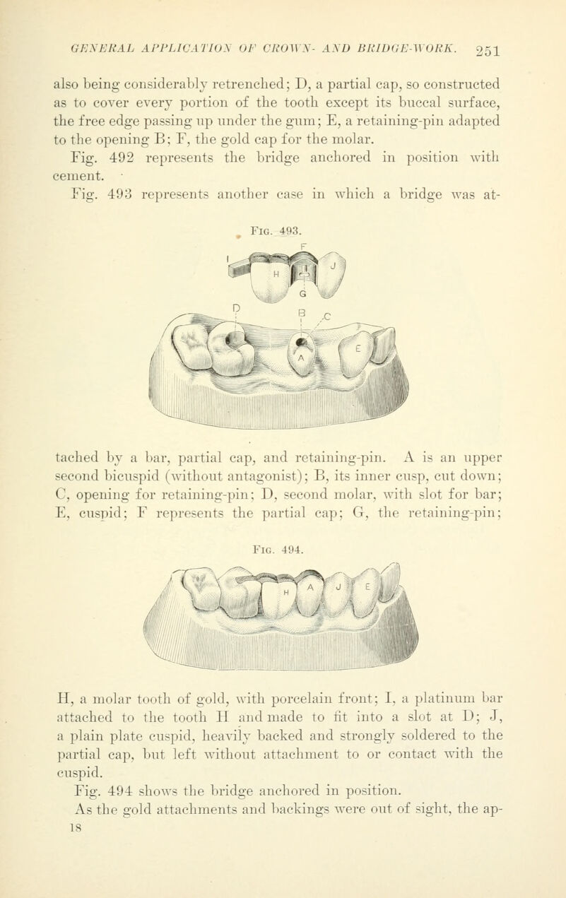 also being considerably retrenched; D, a partial cap, so constructed as to cover every portion of the tooth except its buccal surface, the free edge passing up under the gum; E, a retaining-piu adapted to the opening B; F, the gold cap for the molar. Fig. 492 represents the bridge anchored in position with cement. Fig. 493 represents another case in which a bridge was at- Fig. 493. tached by a bar, partial cap, and retaining-pin. A is an upper second bicuspid (without antagonist); B, its inner cusp, cut down; C, opening for retaining-pin; D, second molar, with slot for bar; E, cuspid; F represents the partial cap; G, the retaining-pin; Fig. 494. H, a molar tooth of gold, with porcelain front; I, a platinum bar attached to the tooth H and made to fit into a slot at D; J, a plain plate cuspid, heavily backed and strongly soldered to the partial cap, but left without attachment to or contact with the cuspid. Fig. 494 shows the bridge anchored in position. As the gold attachments and backings were out of sight, the ap- 18