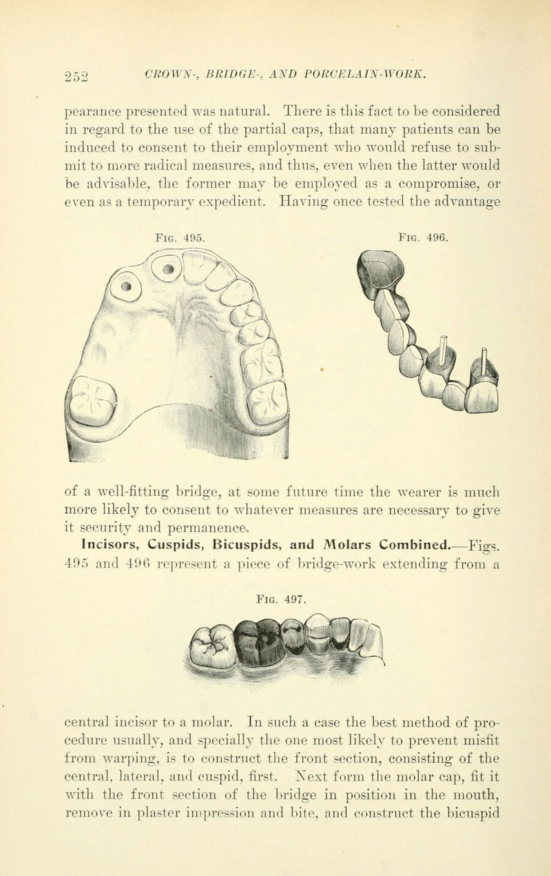 pearance presented was natural. There is this fact to be considered in regard to the use of the partial caps, that many patients can be induced to consent to their employment who would refuse to sub- mit to more radical measures, and thus, even when the latter would be advisable, the former may be employed as a compromise, or even as a temporary expedient. Having once tested the advantage Fig. 495. Fig. 496. of a well-fitting bridge, at some future time the wearer is much more likely to consent to whatever measures are necessary to give it security and permanence^ Incisors, Cuspids, Bicuspids, and Molars Combined.—Figs. 495 and 496 represent a piece of bridge-work extending from a Fig. 497. central incisor to a molar. In such a case the best method of pro- cedure usually, and specially the one most likely to prevent misfit from warping, is to construct the front section, consisting of the central, lateral, and cuspid, first. Xext form the molar cap, fit it with the front section of the bridge in position in the mouth, remove in plaster impression and bite, and construct the bicuspid