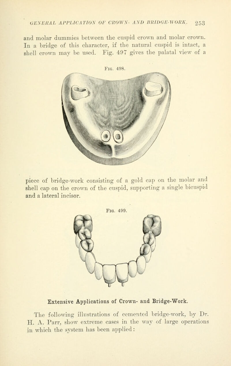 and molar dummies between the cuspid crown and molar crown. In a bridge of this character, if the natural cuspid is intact, a shell crown may be used. Fig. 497 gives the palatal view of a Fig. 498. piece of bridge-work consisting of a gold cap on the molar and shell cap on the crown of the cuspid, supporting a single bicuspid and a lateral incisor. Fig. 499. Extensive Applications of Crown- and Bridge-Work. The following illustrations of cemented bridge-work, by Dr. H. A. Parr, show extreme cases in the way of large operations in which the system has been applied: