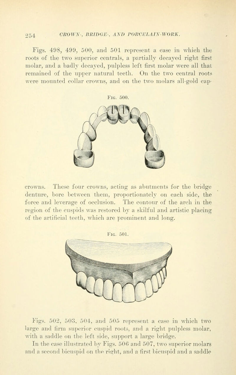 Figs. 498, 499, 500, and 501 represent a case in which the roots of the two superior centrals, a partially decayed right first molar, and a badly decayed, pulpless left first molar were all that remained of the upper natural teeth. On the two central roots were mounted collar crowns, and on the two molars all-gold cap- Fig. 500. crowns. These four crowns, acting as abutments for the bridge denture, bore between them, proportionately on each side, the force and leverage of occlusion. The contour of the arch in the region of the cuspids was restored by a skilful and artistic placing of the artificial teeth, which are prominent and long. Fig Figs. 502, 503, 504, and 505 represent a case in which two large and firm superior cuspid roots, and a right pulpless molar, with a saddle on the left side, support a large bridge. In the case illustrated by Figs. 506 and 507, two superior molars and a second bicuspid on the right, and a first bicuspid and a saddle