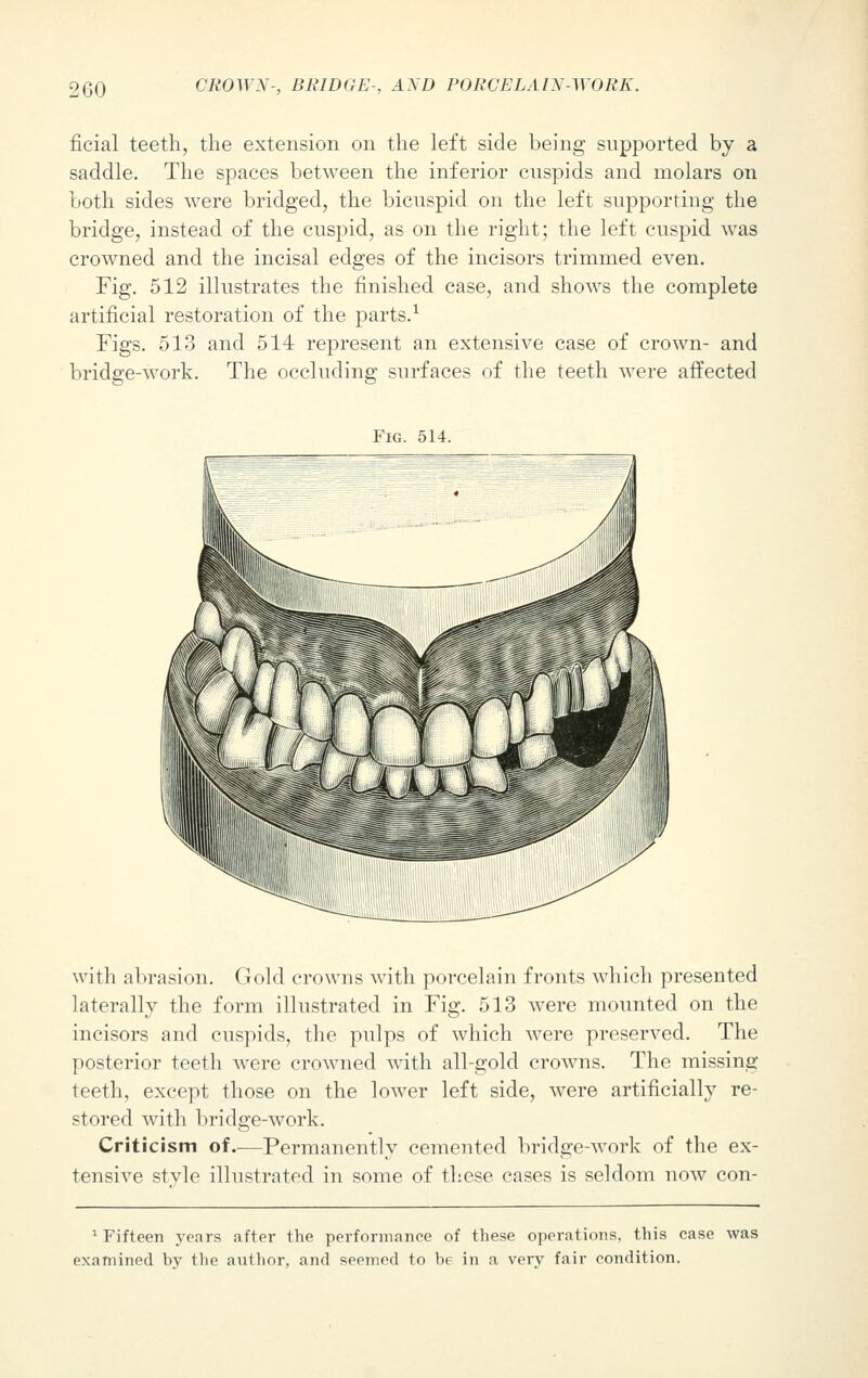 ficial teeth, the extension on the left side being supported by a saddle. The spaces between the inferior cuspids and molars on both sides were bridged, the bicuspid on the left supporting the bridge, instead of the cuspid, as on the right; the left cuspid was crowned and the incisal edges of the incisors trimmed even. Fig. 512 illustrates the finished case, and shows the complete artificial restoration of the parts.1 Figs. 513 and 514 represent an extensive case of crown- and bridge-work. The occluding surfaces of the teeth were affected Fig. 514. with abrasion. Gold crowns with porcelain fronts which presented laterally the form illustrated in Fig. 513 were mounted on the incisors and cuspids, the pulps of which were preserved. The posterior teeth were crowned with all-gold crowns. The missing- teeth, except those on the lower left side, were artificially re- stored with bridge-work. Criticism of.-—Permanently cemented bridge-work of the ex- tensive stvle illustrated in some of these cases is seldom now con- 1 Fifteen years after the performance of these operations, this case was examined by the author, and seemed to be in a very fair condition.