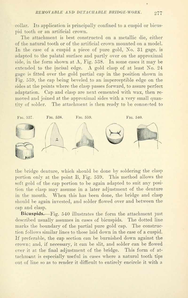 collar. Its application is principally confined to a cuspid or bicus- pid tooth or an artificial crown. The attachment is best constructed on a metallic die, either of the natural tooth or of the artificial crown mounted on a model. In the case of a cuspid a piece of pure gold, ]STo. 31 gage, is adapted to the palatal surface and partly over on the approximal side, in the form shown at A, Fig. 538. In some cases it may be extended to the incisal edge. A gold clasp of at least No. 24 gage is fitted over the gold partial cap in the position shown in Fig. 539, the cap being beveled to an imperceptible edge on the sides at the points where the clasp passes forward, to assure perfect adaptation. Cap and clasp are next cemented with wax, then re- moved and joined at the approximal sides with a very small quan- tity of solder. The attachment is then ready to be connected to Fig. 537. Fig. 538. Fig. 539. Fig. 540. the bridge denture, which should be done by soldering the clasp portion only at the point B, Fig. 539. This method allows the soft gold of the cap portion to be again adapted to suit any posi- tion the clasp may assume in a later adjustment of the denture in the mouth. AVhen this has been done, the bridge and clasp should be again invested, and solder flowed over and between the cap and clasp. Bicuspids.—Fig. 540 illustrates the form the attachment just described usually assumes in cases of bicuspids. The dotted line marks the boundary of the partial pure gold cap. The construc- tion follows similar lines to those laid down in the case of a cuspid. If preferable, the cap section can be burnished down against the crown: and, if necessary, it can be slit, and solder can be flowed over it at the final adjustment of the bridge. This form of at- tachment is especially useful in cases where a natural tooth tips out of line so as to render it difficult to entirely encircle it with a