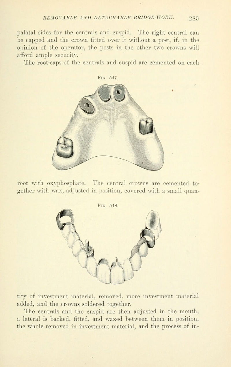 palatal sides for the centrals and cuspid. The right central can be capped and the crown fitted over it without a post, if, in the opinion of the operator, the posts in the other two crowns will afford ample security. The root-caps of the centrals and cuspid are cemented on each Fig. 547. root with oxyphosphate. The central crowns are cemented to- gether with wax, adjusted in position, covered with a small quan- Fig. 548. tity of investment material, removed, more investment material added, and the crowns soldered together. The centrals and the cuspid are then adjusted in the mouth, a lateral is backed, fitted, and waxed between them in position, the whole removed in investment material, and the process of in-