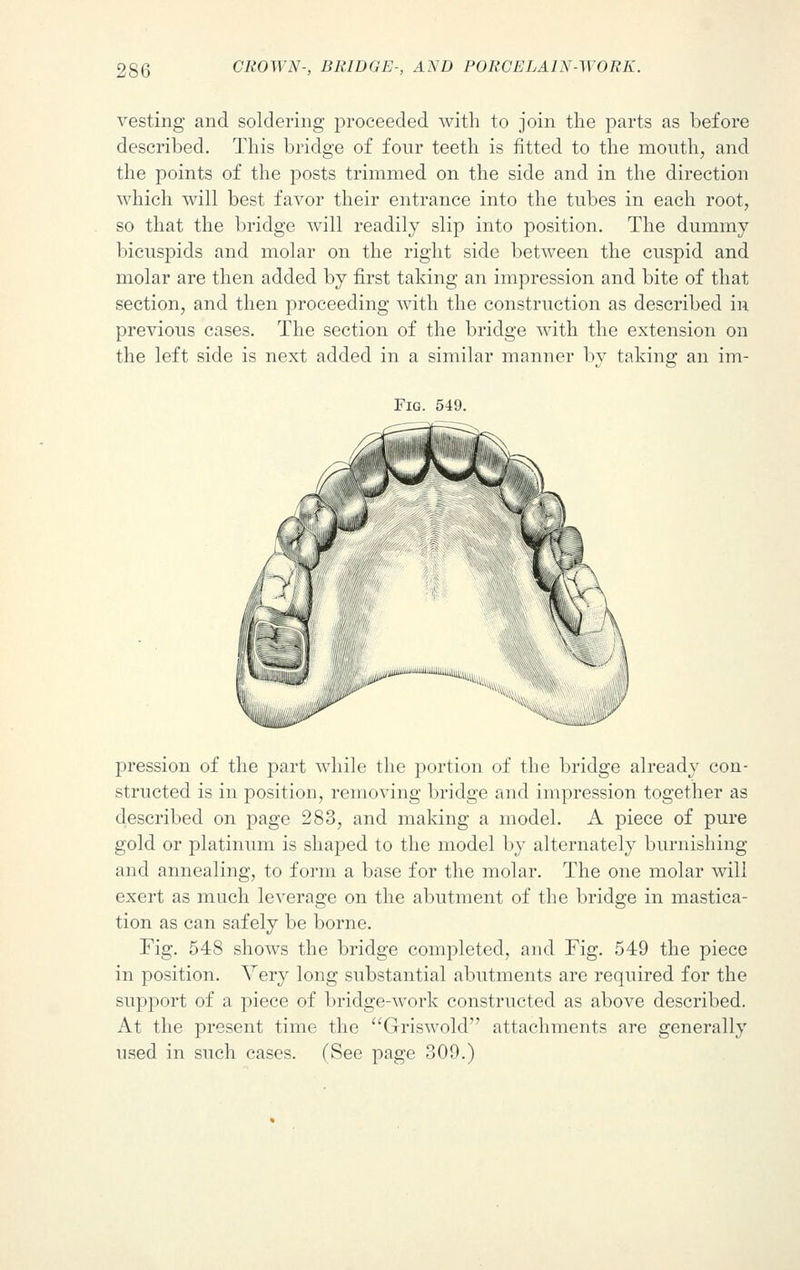 vesting and soldering proceeded with to join the parts as before described. This bridge of four teeth is fitted to the mouth, and the points of the posts trimmed on the side and in the direction which will best favor their entrance into the tubes in each root, so that the bridge will readily slip into position. The dummy bicuspids and molar on the right side between the cuspid and molar are then added by first taking an impression and bite of that section, and then proceeding with the construction as described in previous cases. The section of the bridge with the extension on the left side is next added in a similar manner by taking an im- FlG. 549. pression of the part while the portion of the bridge already con- structed is in position, removing bridge and impression together as described on page 283, and making a model. A piece of pure gold or platinum is shaped to the model by alternately burnishing and annealing, to form a base for the molar. The one molar will exert as much leverage on the abutment of the bridge in mastica- tion as can safely be borne. Fig. 548 shows the bridge completed, and Fig. 549 the piece in position. Very long substantial abutments are required for the support of a piece of bridge-work constructed as above described. At the present time the Griswold attachments are generally used in such cases. (See page 309.)