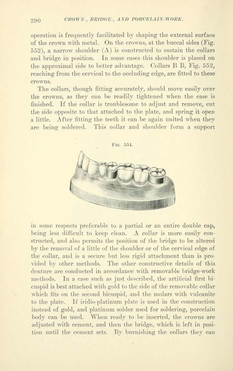 operation is frequently facilitated by shaping the external surface of the crown with metal. On the crowns, at the buccal sides (Fig. 552), a narrow shoulder (A) is constructed to sustain the collars and bridge in position. In some cases this shoulder is placed on the approximal side to better advantage. Collars B B, Fig. 552, reaching from the cervical to the occluding edge, are fitted to these crowns. The collars, though fitting accurately, should move easily over the crowns, as they can be readily tightened when the case is finished. If the collar is troublesome to adjust and remove, cut the side opposite to that attached to the plate, and spring it open a little. After fitting the teeth it can be again united when they are being soldered. This collar and shoulder form a support Fig. 554. in some respects preferable to a partial or an entire double cap, being less difficult to keep clean. A collar is more easily con- structed, and also permits the position of the bridge to be altered by the removal of a little of the shoulder or of the cervical edge of the collar, and is a secure but less rigid attachment than is pro- vided by other methods. The other constructive details of this denture are conducted in accordance with removable bridge-work methods. In a case such as just described, the artificial first bi- cuspid is best attached with gold to the side of the removable collar which fits on the second bicuspid, and the molars with vulcanite to the plate. If iridio-platinum plate is used in the construction instead of gold, and platinum solder used for soldering, porcelain body can be used. When ready to be inserted, the crowns are adjusted with cement, and then the bridge, which is left in posi- tion until the cement sets. By burnishing the collars they can