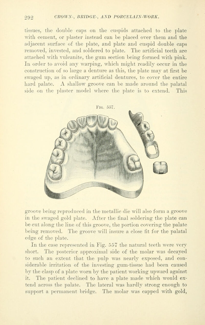 tissues, the double caps on the cuspids attached to the plate with cement, or plaster instead can be placed over them and the adjacent surface of the plate, and plate and cuspid double caps removed, invested, and soldered to plate. The artificial teeth are attached with vulcanite, the gum section being formed with pink. In order to avoid any warping, which might readily occur in the construction of so large a denture as this, the plate may at first be swaged up, as in ordinary artificial dentures, to cover the entire hard palate. A shallow groove can be made around the palatal side on the plaster model where the plate is to extend. This groove being reproduced in the metallic die will also form a groove in the swaged gold plate. After the final soldering the plate can be cut along the line of this groove, the portion covering the palate being removed. The groove will insure a close fit for the palatal edge of the plate. In the case represented in Tig. 557 the natural teeth were very short. The posterior approximal side of the molar was decayed to such an extent that the pulp was nearly exposed, and con- siderable irritation of the investing gum-tissue had been caused by the clasp of a plate worn by the patient working upward against it. The patient declined to have a plate made which would ex- tend across the palate. The lateral was hardly strong enough to support a permanent bridge. The molar was capped with gold,
