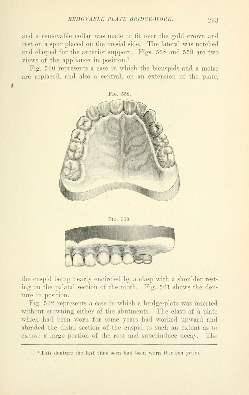 and a removable collar was made to lit over the gold crown and rest on a spur placed on the mesial side. The lateral was notched and clasped for the anterior support. Tigs. 55S and 559 are two views of the appliance in position.1 Pig. 560 represents a case in which the bicuspids and a molar are replaced, and also a central, on an extension of the plate, Fig. 559. the cuspid being nearly encircled by a clasp with a shoulder rest- ing on the palatal section of the tooth. Fig. 501 shows the den- ture in position. Fig. 562 represents a case in which a bridge-plate was inserted without crowning either of the abutments. The clasp of a plate which had been worn for some years had worked upward and abraded the distal section of the cuspid to such an extent as to expose a large portion of the root and superinduce decay. The This denture the last time seen had been worn thirteen years.