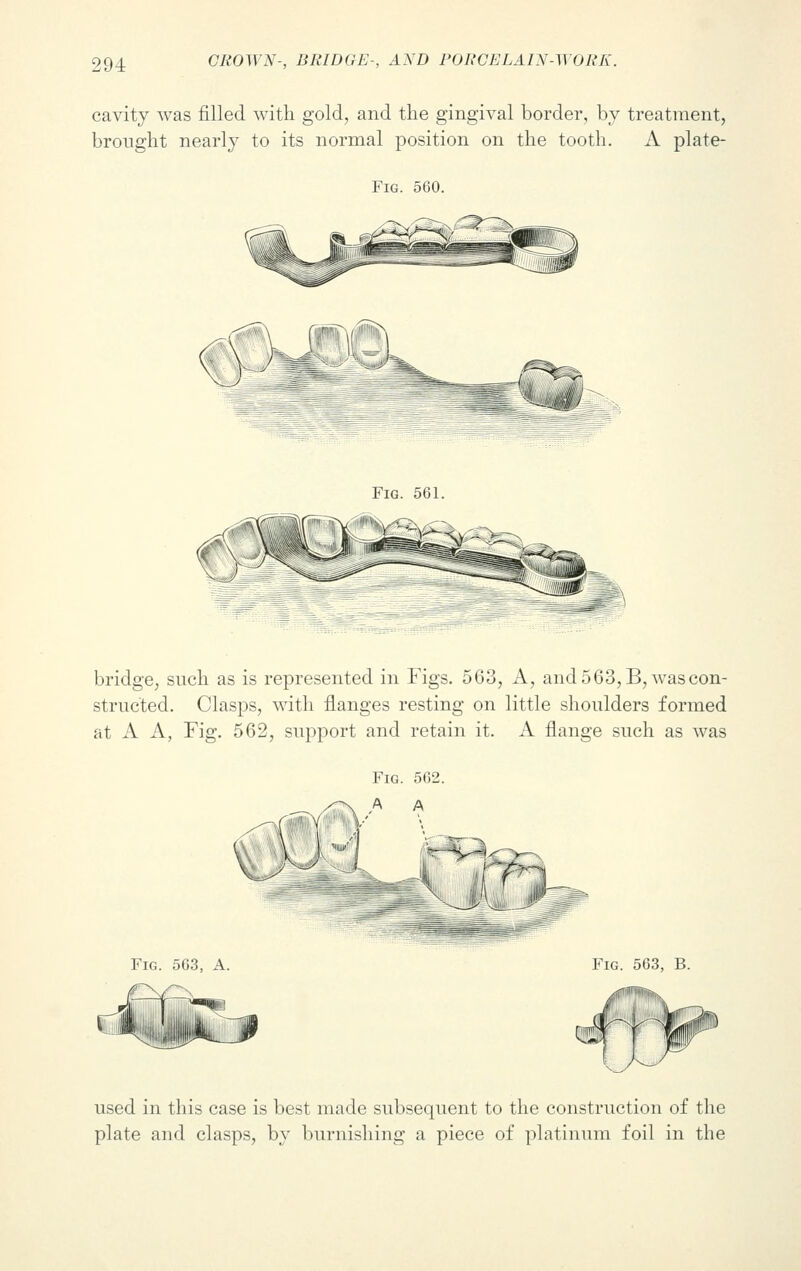cavity was filled with gold, and the gingival border, by treatment, brought nearly to its normal position on the tooth. A plate- Fig. 560. Fig. 561. bridge, such as is represented in Figs. 563, A, and 563, B, was con- structed. Clasps, with flanges resting on little shoulders formed at A A, Fig. 562, support and retain it. A flange such as was Fig. 562. Fig. 563, A. Fig. 563, B. used in this case is best made subsequent to the construction of the plate and clasps, by burnishing a piece of platinum foil in the