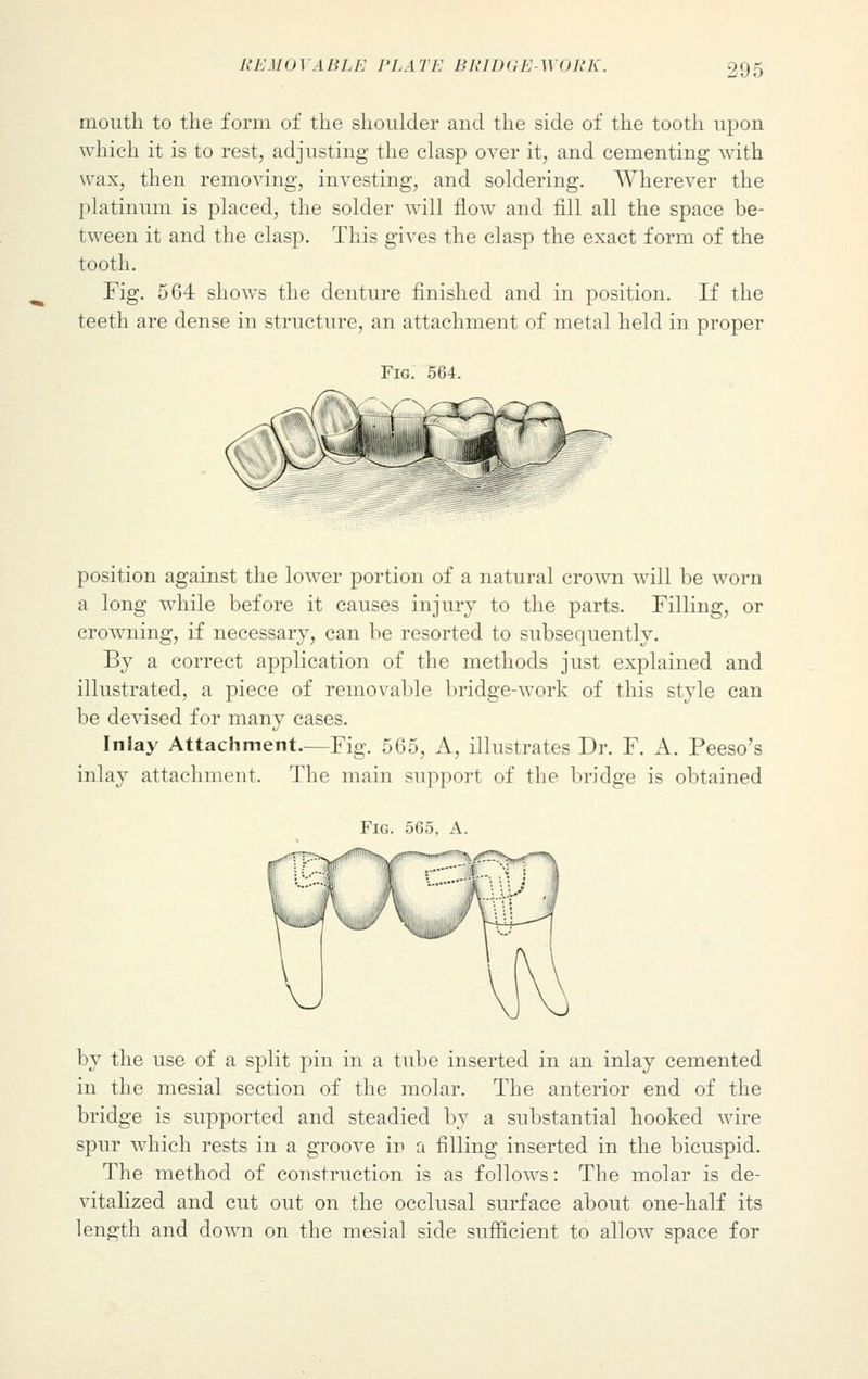 mouth to the form of the shoulder and the side of the tooth upon which it is to rest, adjusting the clasp over it, and cementing with wax, then removing, investing, and soldering. Wherever the platinum is placed, the solder will flow and fill all the space be- tween it and the clasp. This gives the clasp the exact form of the tooth. Fig. 564 shows the denture finished and in position. If the teeth are dense in structure, an attachment of metal held in proper Fig. 564. position against the lower portion of a natural crown will be worn a long while before it causes injury to the parts. Filling, or crowning, if necessary, can be resorted to subsequently. By a correct application of the methods just explained and illustrated, a piece of removable bridge-work of this style can be devised for many cases. Inlay Attachment.—Fig. 5G5, A, illustrates Dr. F. A. Peeso's inlay attachment. The main support of the bridge is obtained Fig. 565, A. by the use of a split pin in a tube inserted in an inlay cemented in the mesial section of the molar. The anterior end of the bridge is supported and steadied by a substantial hooked wire spur which rests in a groove in a filling inserted in the bicuspid. The method of construction is as follows: The molar is de- vitalized and cut out on the occlusal surface about one-half its length and down on the mesial side sufficient to allow space for