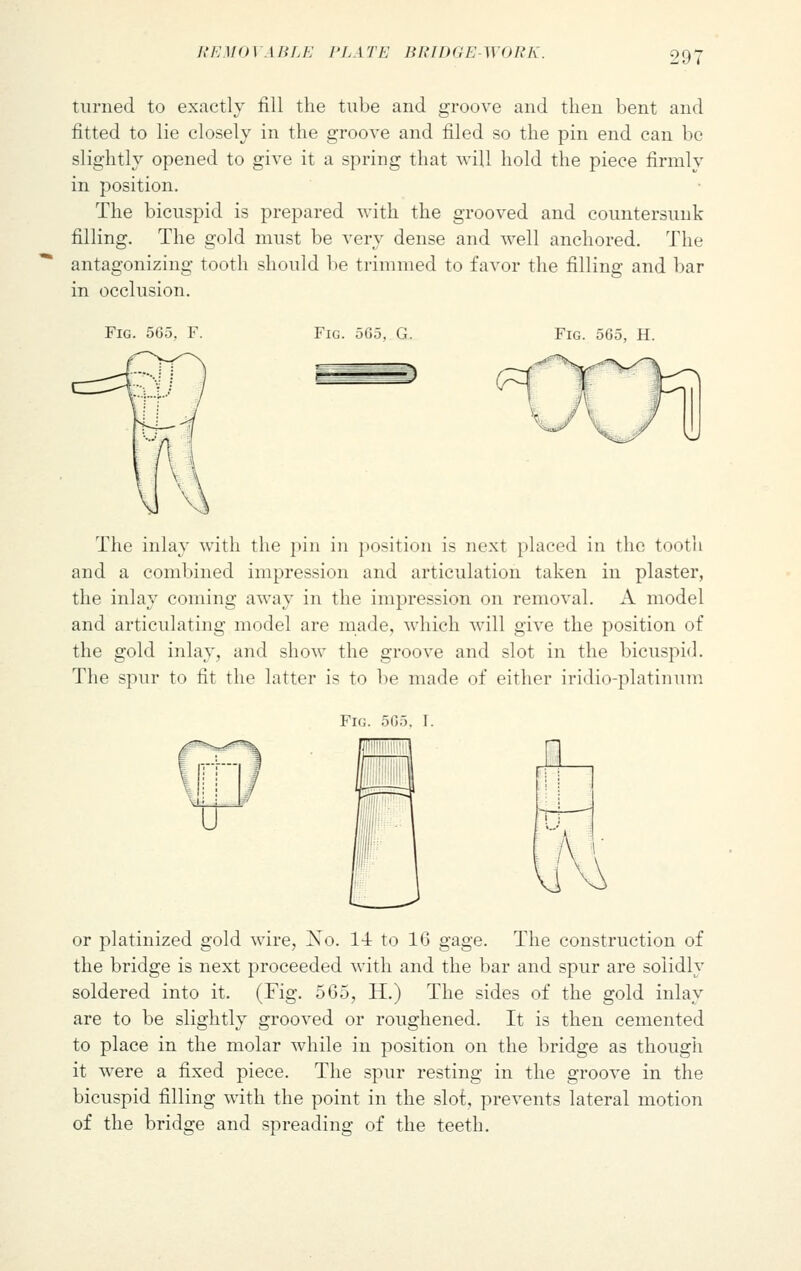 R E MOV A IIL K PL A TE BR ID GE-M<>h'l\. turned to exactly fill the tube and groove and then bent and fitted to lie closely in the groove and filed so the pin end can be slightly opened to give it a spring that will hold the piece firmly in position. The bicuspid is prepared with the grooved and countersunk filling. The gold must be very dense and well anchored. The antagonizing tooth should be trimmed to favor the filling and bar in occlusion. Fig. 505, F. Fig. 565, G. Fig. 565, H. The inlay with the pin in position is next placed in the tooth and a combined impression and articulation taken in plaster, the inlay coming away in the impression on removal. A model and articulating model are made, which will give the position of the gold inlay, and show the groove and slot in the bicuspid. The spur to fit the latter is to be made of either iridio-platinum Fig. 565. I. or platinized gold wire, Ko. M to 10 gage. The construction of the bridge is next proceeded with and the bar and spur are solidly soldered into it. (Fig. 565, H.) The sides of the gold inlay are to be slightly grooved or roughened. It is then cemented to place in the molar while in position on the bridge as though it were a fixed piece. The spur resting in the groove in the bicuspid filling with the point in the slot, prevents lateral motion of the bridge and spreading of the teeth.