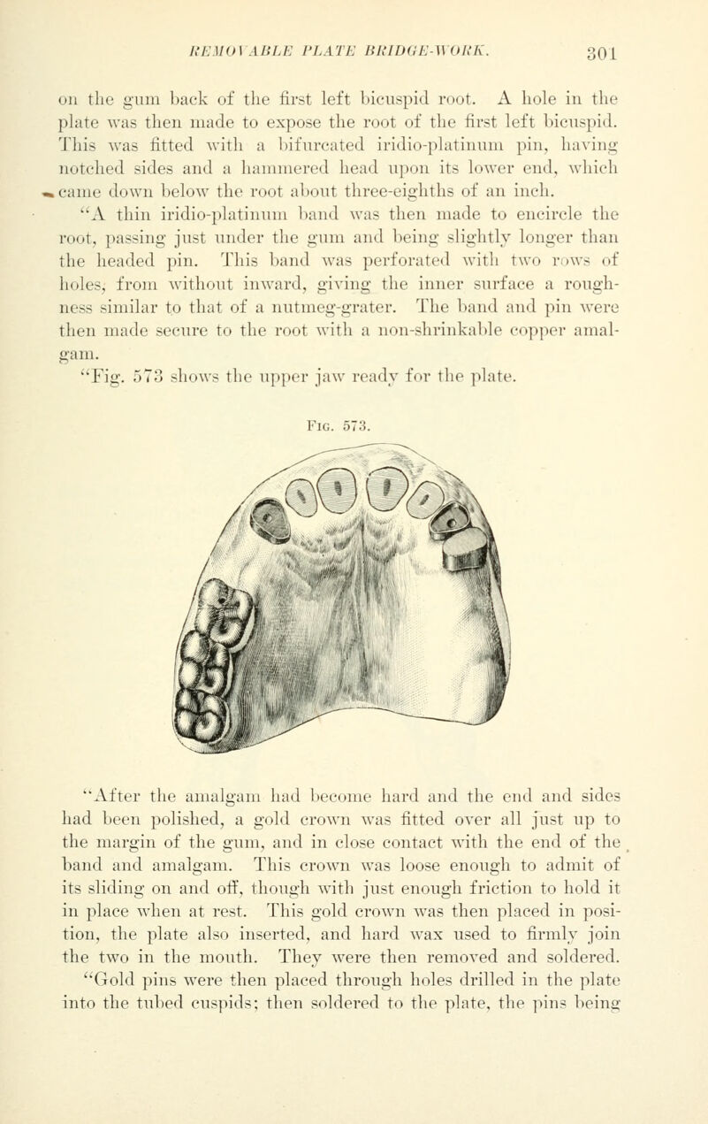 i;i:\l(t\ ABLE PL 177. BRIDGE-WORK. ;oi on the gum back of the first left bicuspid root. A hole in the plate was then made to expose the root of the first left bicuspid. This was fitted with a bifurcated iridio-platinum pin, having notched sides and a hammered head upon its lower end. which came down below the root about three-eighths of an inch. A thin iridio-platinum band was then made to encircle the root, passing just under the gum and being slightly longer than the headed pin. This band was perforated with two rows of holes; from without inward, giving the inner surface a rough- ness similar to that of a nutmeg-grater. The band and pin were then made secure to the root with a non-shrinkable copper amal- gam. Fig. 573 shows the upper jaw ready for the plate. Fig. -iT.'i. After the amalgam had become hard and the end and sides had been polished, a gold crown was fitted over all just up to the margin of the gum, and in close contact with the end of the band and amalgam. This crown was loose enough to admit of its sliding on and off, though with just enough friction to hold it in place when at rest. This gold crown was then placed in posi- tion, the plate also inserted, and hard wax used to firmly join the two in the mouth. They were then removed and soldered. Gold pins were then placed through holes drilled in the plate into the tubed cuspids; then soldered to the plate, the pins being