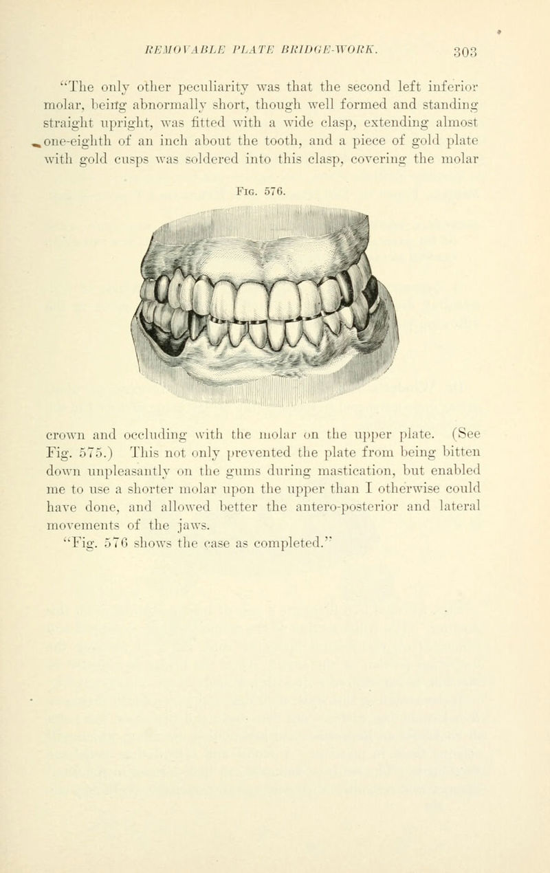 The only other peculiarity was that the second left inferior molar, being abnormally short, though well formed and standing straight upright, was fitted with a wide clasp, extending almost , one-eighth of an inch about the tooth, and a piece of gold plate with gold cusps was soldered into this clasp, covering the molar Fig. 576. crown and occluding with the molar on the upper plate. (See Fig. 575.) This not only prevented the plate from being bitten down unpleasantly on the gums during mastication, but enabled me to use a shorter molar upon the upper than I otherwise could have done, and allowed better the antero-posterior and lateral movements of the jaws. Fig. 576 shows the case as completed.''