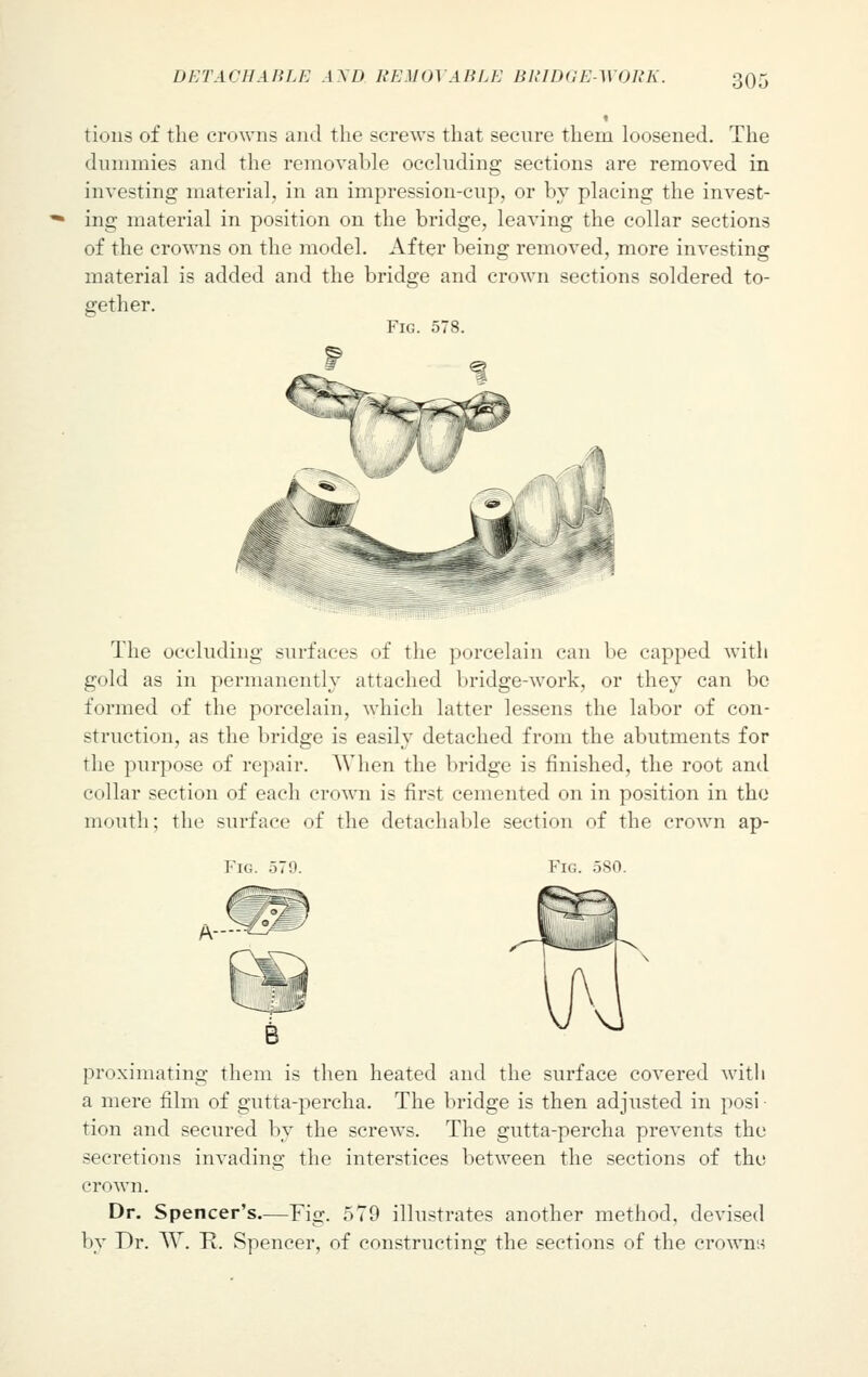 tious of the crowns and the screws that secure them loosened. The dummies and the removable occluding sections are removed in investing material, in an impression-cup, or by placing the invest- ing material in position on the bridge, leaving the collar sections of the crowns on the model. After being removed, more investing material is added and the bridge and crown sections soldered to- gether. Fig. 578. The occluding surfaces of the porcelain can be capped with gold as in permanently attached bridge-work, or they can be formed of the porcelain, which latter lessens the labor of con- struction, as the bridge is easily detached from the abutments for the purpose of repair. When the bridge is finished, the root and collar section of each crown is first cemented on in position in the mouth; the surface of the detachable section of the crown ap- Fig. 579. Fig. 580. proximating them is then heated and the surface covered with a mere film of gutta-percha. The bridge is then adjusted in posi ■ tion and secured by the screws. The gutta-percha prevents the secretions invading the interstices between the sections of the Dr. Spencer's.—Fig. 579 illustrates another method, devised by Dr. W. R. Spencer, of constructing the sections of the crowns