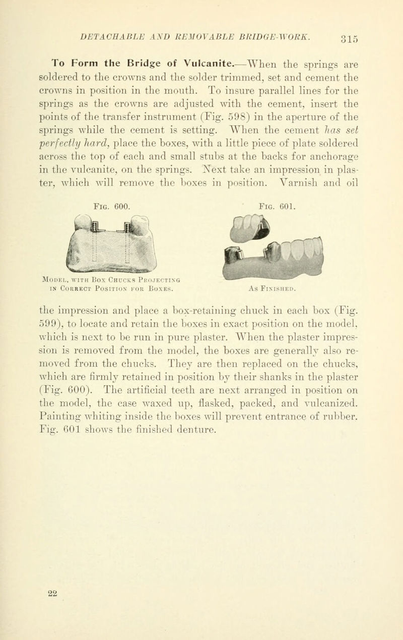 To Form the Bridge of Vulcanite.—When the springs are soldered to the crowns and the solder trimmed, set and cement the crowns in position in the month. To insnre parallel lines for the springs as the crowns are adjusted with the cement, insert the points of the transfer instrument (Fig. 598) in the aperture of the springs while the cement is setting. When the cement has set perfectly hard, place the boxes, with a little piece of plate soldered across the top of each and small stubs at the backs for anchorage in the vulcanite, on the springs. Xext take an impression in plas- ter, which will remove the boxes in position. Varnish and oil Fig. 600. Fig. G01. .Mohk 1., with I!o\ Chi i ; - P l I ting in Correct Position i ok Boxes. As Pikisi the impression and place ;i box-retaining chuck in each box (Fig. 599), to locate and retain the boxes in exa<-t position on the model, which is next to be run in pure plaster. When the plaster impres- sion is removed from the model, the boxes are generally also re- moved from the chucks. They are then replaced on the chucks, which are firmly retained in position by their shanks in the plaster (Fig. 600). The artificial teeth are next arranged in position on the model, the case waxed up, flasked, packed, and vulcanized. Painting whiting inside the boxes will prevent entrance of rubber. Fig. 001 shows the finished denture. 22