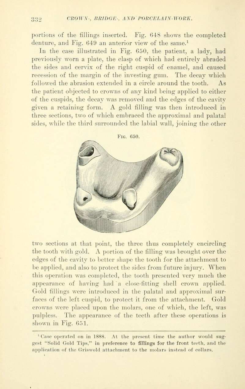 portions of the fillings inserted. Fig. 648 shows the completed denture, and Fig. 649 an anterior view of the same.1 In the case illustrated in Fig. 650, the patient, a lady, had previously worn a plate, the clasp of which had entirely abraded the sides and cervix of the right cuspid of enamel, and caused recession of the margin of the investing gum. The decay which followed the abrasion extended in a circle around the tooth. As the patient objected to crowns of any kind being applied to either of the cuspids, the decay was removed and the edges of the cavity given a retaining form. A gold filling was then introduced in three sections, two of which embraced the approximal and palatal sides, while the third surrounded the labial Avail, joining the other Fig. 650. two sections at that point, the three thus completely encircling the tooth with gold. A portion of the filling was brought over the edges of the cavity to better shape the tooth for the attachment to be applied, and also to protect the sides from future injury. When this operation was completed, the tooth presented very much the appearance of having had a close-fitting shell crown applied. Gold fillings were introduced in the palatal and approximal sur- faces of the left cuspid, to protect it from the attachment. Gold crowns were placed upon the molars, one of which, the left, was pulpless. The appearance of the teeth after these operations is shown in Fig. 651. 1 Case operated on in 1888. At the present time the author would sug- gest Solid Gold Tips. in preference to fillings for the front teeth, and the application of the Griswold attachment to the molars instead of collars.