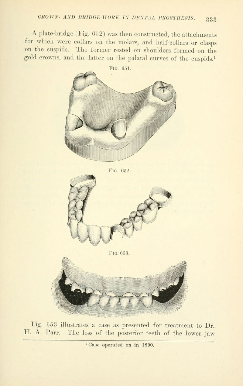 A plate-bridge (Fig. 652) was then constructed, the attachments for which were collars on the molars, and half-collars or clasps on the cuspids. The former rested on shoulders formed on the gold crowns, and the latter on the palatal curves of the cuspids.1 Fig. 651. Fig. 052. Fig. 653 illustrates a case as presented for treatment to Dr. H. A. Parr. The loss of the posterior teeth of the lower jaw 1 Case operated on in 1890.
