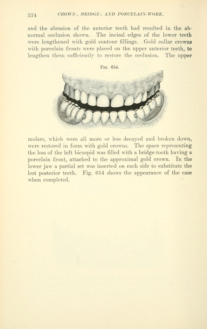 and the abrasion of the anterior teeth had resulted in the ab- normal occlusion shown. The incisal edges of the lower teeth were lengthened with gold contour fillings. Gold collar crowns with porcelain fronts were placed on the upper anterior teeth, to lengthen them sufficiently to restore the occlusion. The upper Fig. 654. molars, which were all more or less decayed and broken down, were restored in form with gold crowns. The space representing the loss of the left bicuspid was filled with a bridge-tooth having a porcelain front, attached to the approximal gold crown. In the lower jaw a partial set was inserted on each side to substitute the lost posterior teeth. Fig. 654 shows the appearance of the case when completed.