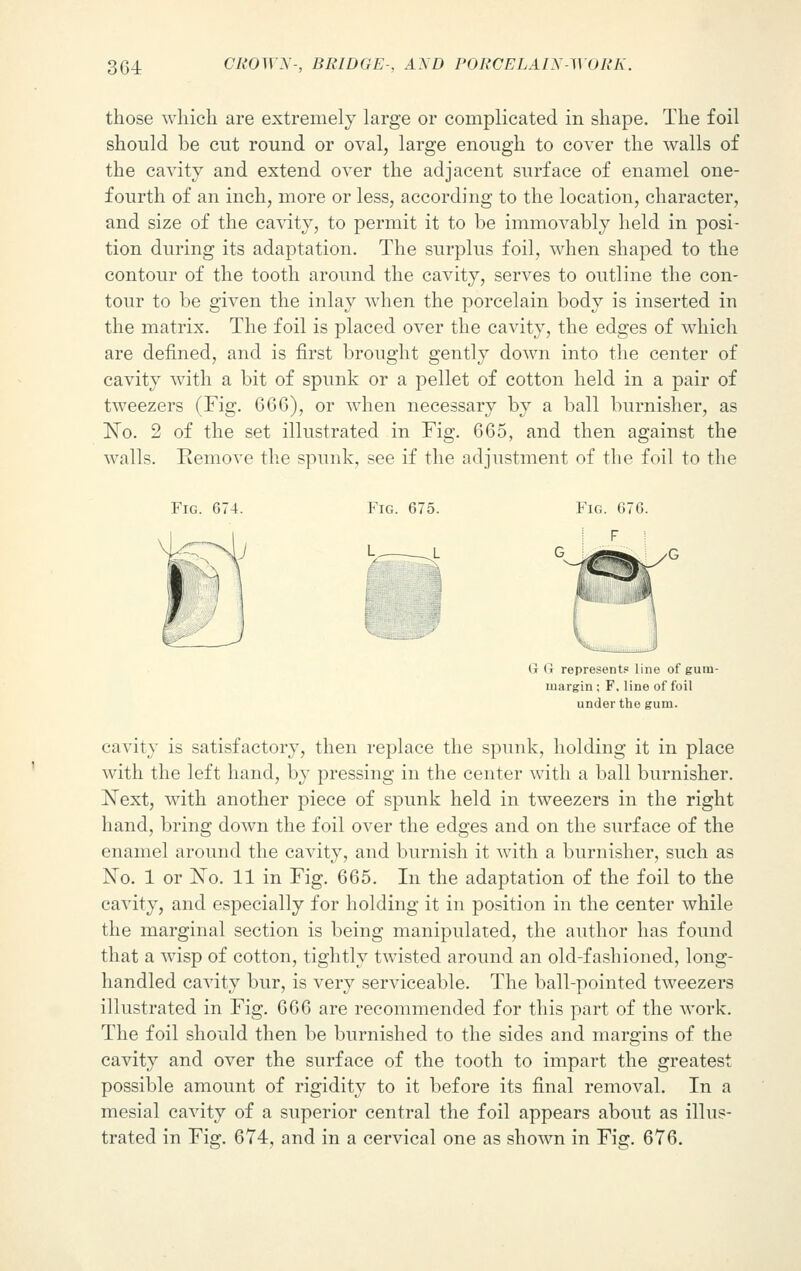 those which are extremely large or complicated in shape. The foil should be cut round or oval, large enough to cover the walls of the cavity and extend over the adjacent surface of enamel one- fourth of an inch, more or less, according to the location, character, and size of the cavity, to permit it to be immovably held in posi- tion during its adaptation. The surplus foil, when shaped to the contour of the tooth around the cavity, serves to outline the con- tour to be given the inlay when the porcelain body is inserted in the matrix. The foil is placed over the cavity, the edges of which are denned, and is first brought gently down into the center of cavity with a bit of spunk or a pellet of cotton held in a pair of tweezers (Fig. 666), or when necessary by a ball burnisher, as No. 2 of the set illustrated in Fig. 665, and then against the walls. Remove the spunk, see if the adjustment of the foil to the Fig. G74. v- , ' G G represents line of gum- margin ; F, line of foil under the gum. cavity is satisfactory, then replace the spunk, holding it in place with the left hand, by pressing in the center with a ball burnisher. Next, with another piece of spunk held in tweezers in the right hand, bring down the foil over the edges and on the surface of the enamel around the cavity, and burnish it with a burnisher, such as No. 1 or No. 11 in Fig. 665. In the adaptation of the foil to the cavity, and especially for holding it in position in the center while the marginal section is being manipulated, the author has found that a wisp of cotton, tightly twisted around an old-fashioned, long- handled cavity bur, is very serviceable. The ball-pointed tweezers illustrated in Fig. 666 are recommended for this part of the work. The foil should then be burnished to the sides and margins of the cavity and over the surface of the tooth to impart the greatest possible amount of rigidity to it before its final removal. In a mesial cavity of a superior central the foil appears about as illus- trated in Fig. 674, and in a cervical one as shown in Fig. 676.
