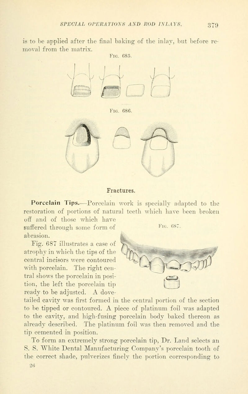 is to be applied after the final baking of the inlay, but before re- moval from the matrix. Fig. 685. Fig. 686. Fractures. Porcelain Tips—Porcelain work is specially adapted to the restoration of portions of natural teeth which have been broken off and of those which have suffered through some form of FlG- os'- abrasion. Pig. 687 illustrates a case of atrophy in which the tips of the central incisors were contoured with porcelain. The right cen- tral shows the porcelain in posi- tion, the left the porcelain tip ready to be adjusted. A dove- tailed cavity was first formed in the central portion of the section to be tipped or contoured. A piece of platinum foil was adapted to the cavity, and high-fusing porcelain body baked thereon as already described. The platinum foil was then removed and the tip cemented in position. To form an extremely strong porcelain tip, Dr. Land selects an S. S. White Dental Manufacturing Company's porcelain tooth of the correct shade, pulverizes finely the portion corresponding to
